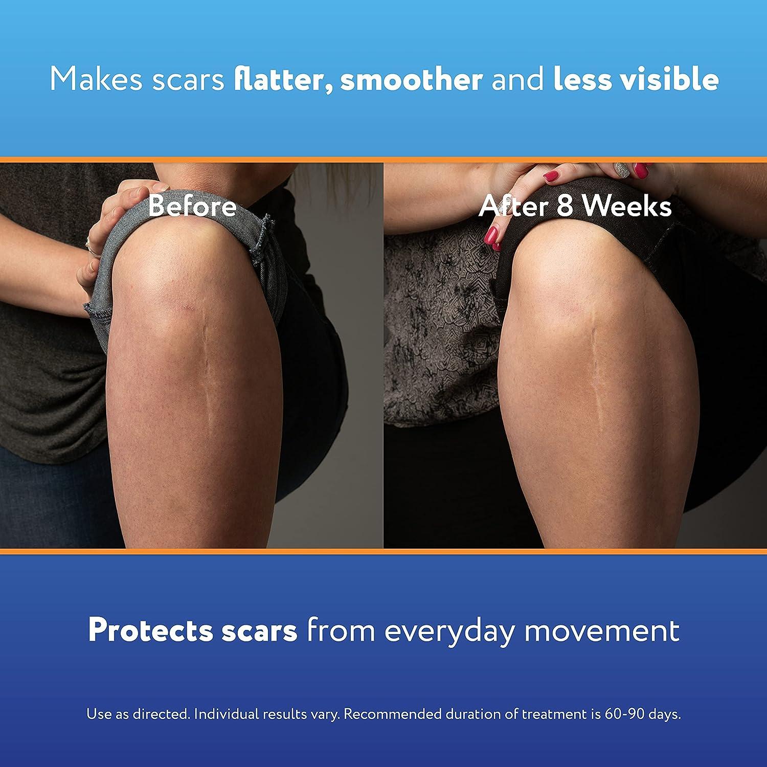 ScarAway Complete Scar Treatment Kit 2 Tan Silicone Scar Sheets and