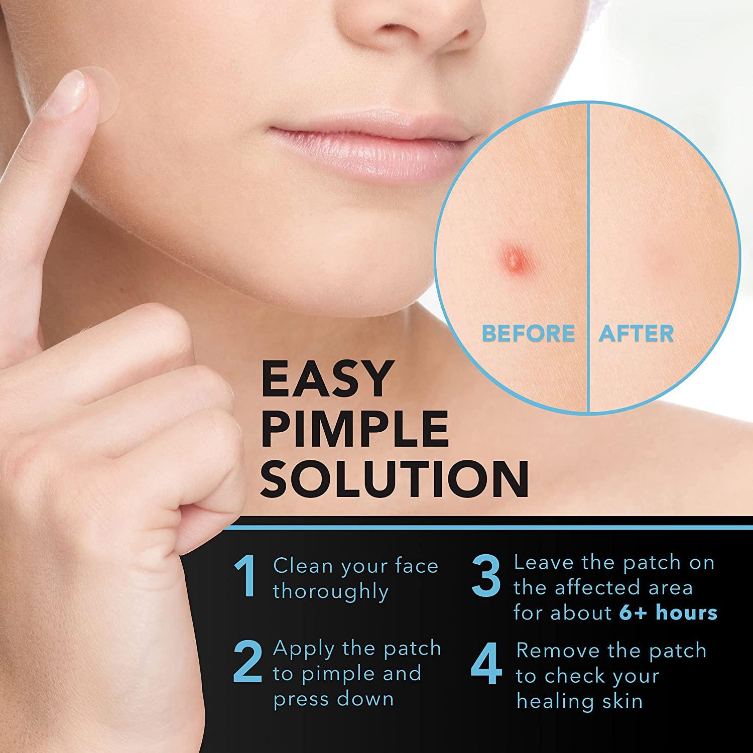 Acne Patches (120 Count) with Tea Tree Oil, Hydrocolloid Pimple Patches