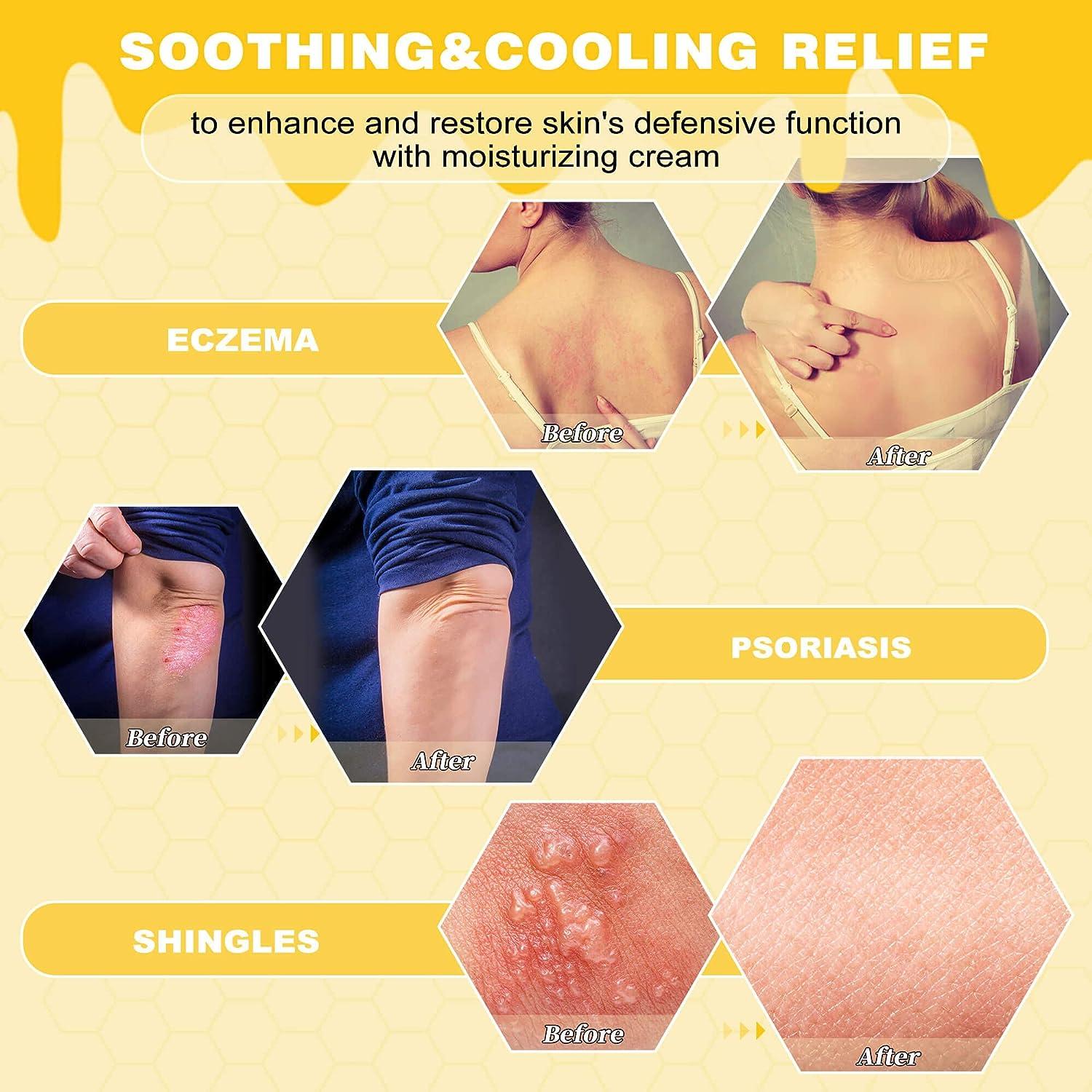 Manuka Honey Eczema Cream Itchy Dry Skin for Relief Colloidal Oatmeal & Manuka Honey Clean