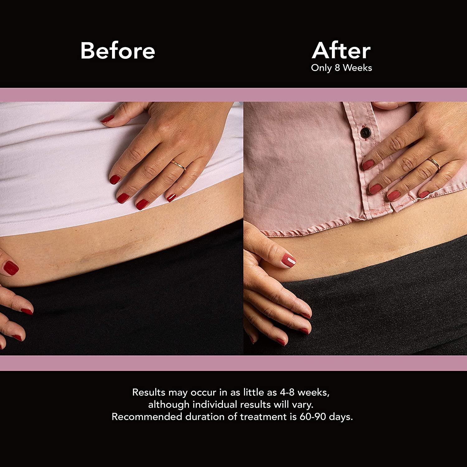 ScarAway Advanced Skincare Silicone Scar Sheets for CSections, Reusable Sheets (1.5 x 7) for