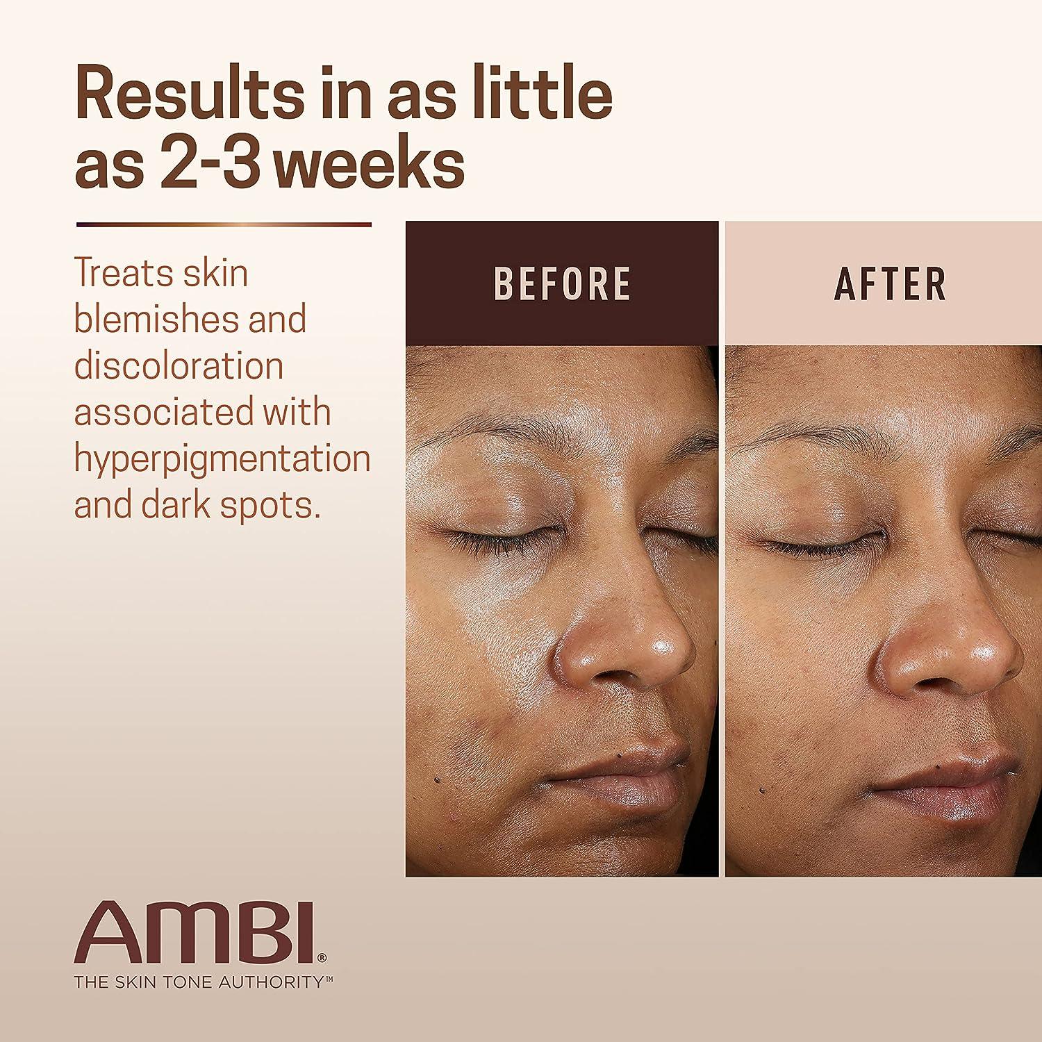 Ambi Even & Clear Fade Cream Hyperpigmentation Treatment, Dark Spot