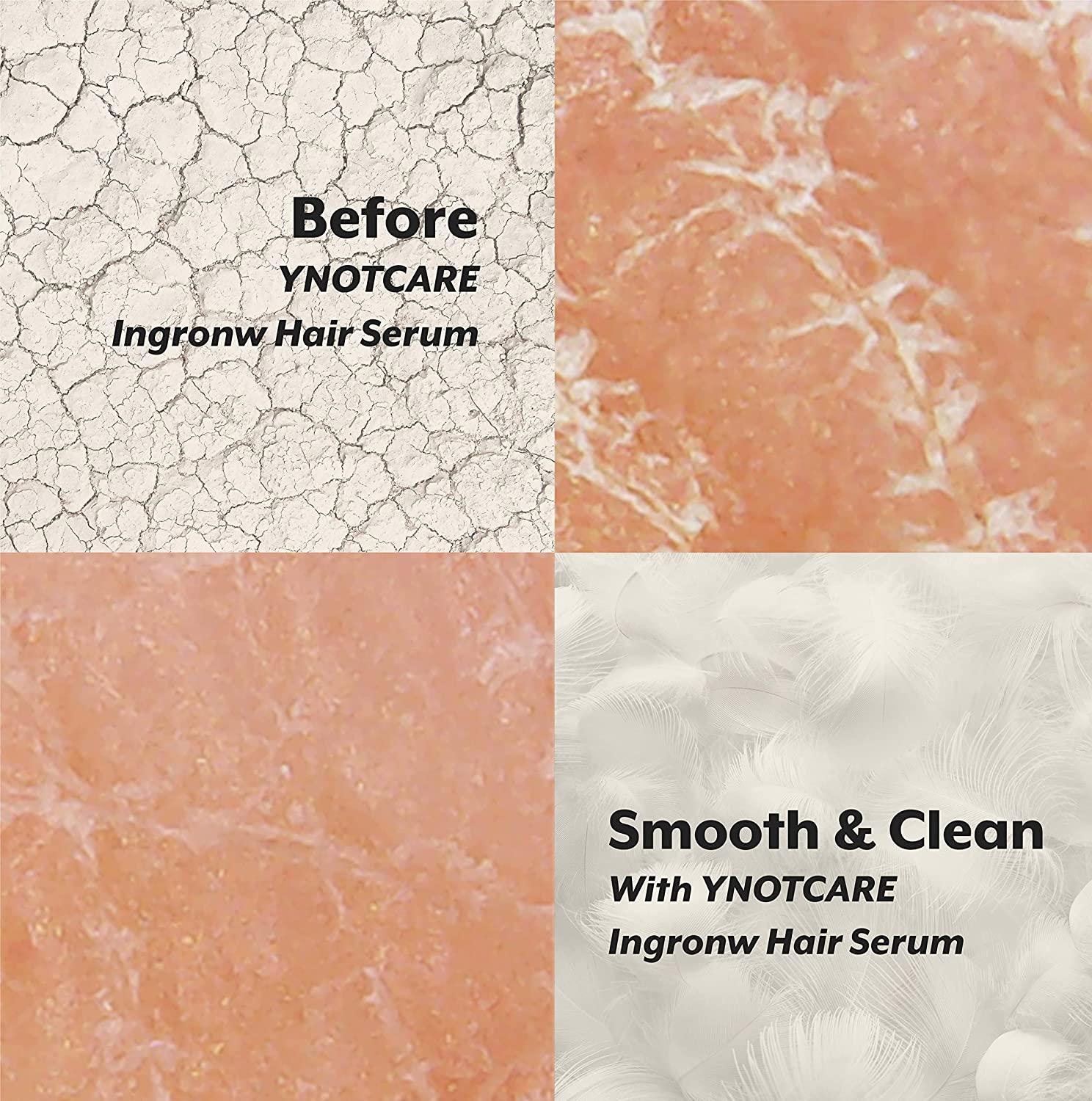 YNOTCARE Ingrown Hair Serum For Bikini Area After Hair Removal Prevent Ingrown Hair, Reduce