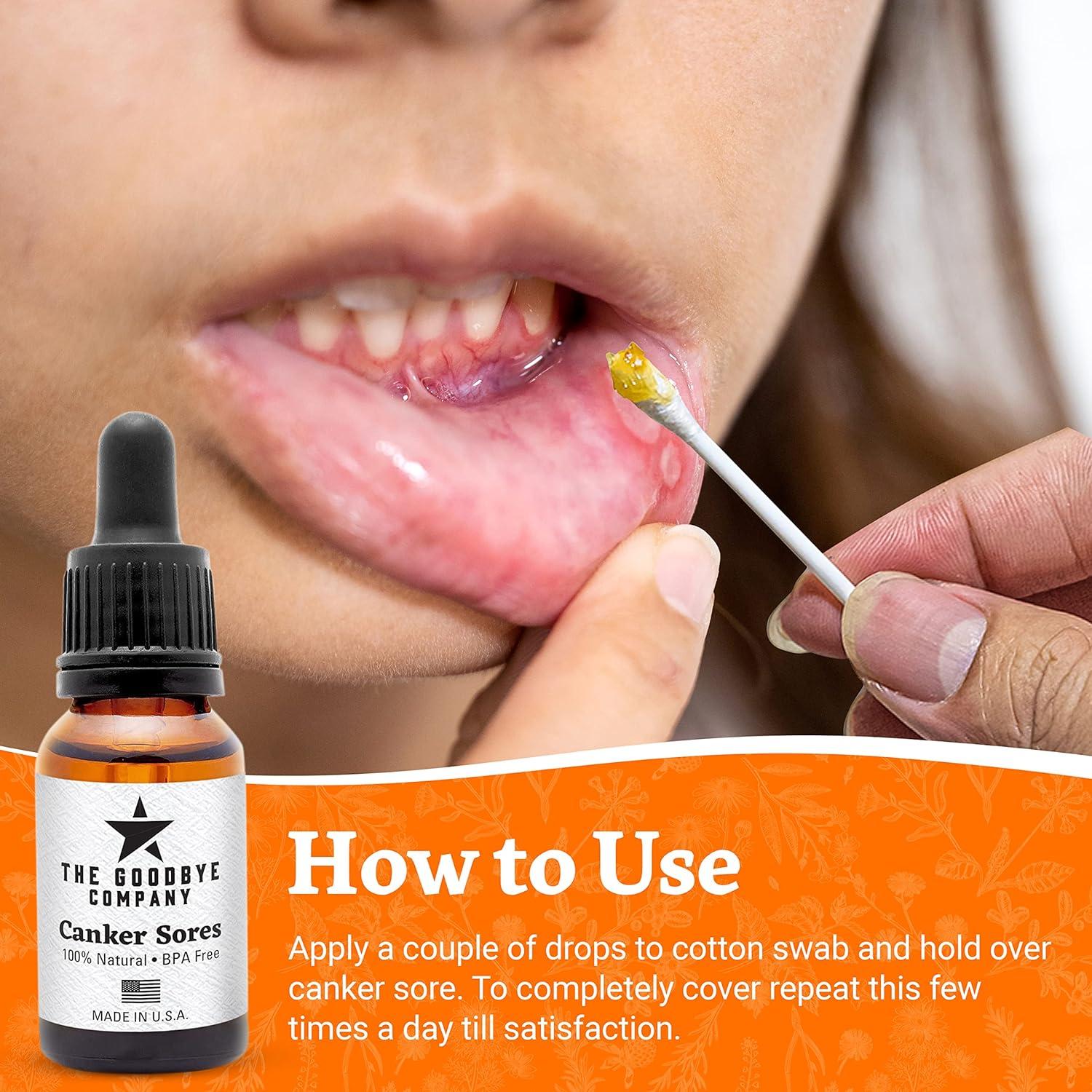 Canker Sores Treatment Helpful for Mouth Ulcer Treatment Effective