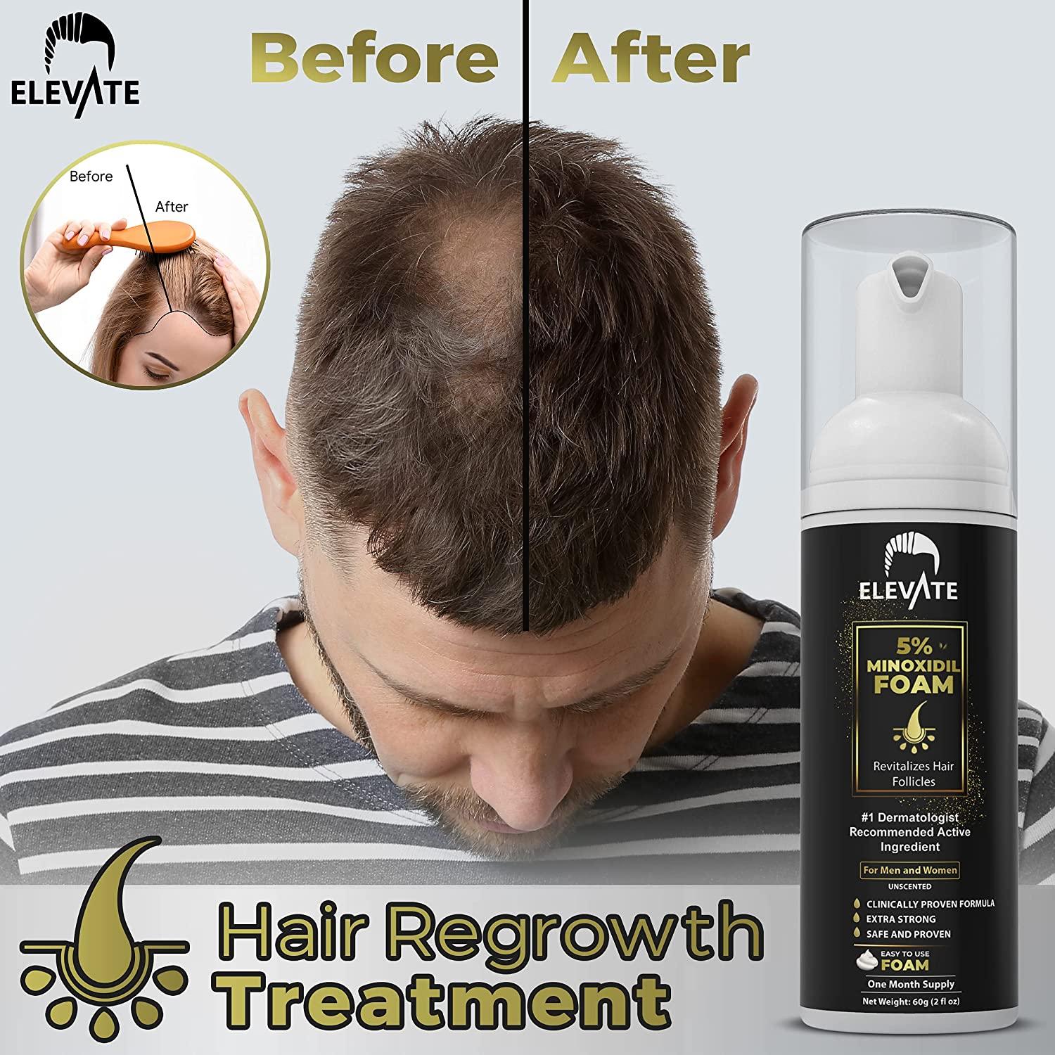 ELEVATE 5% Minoxidil Foam for Hair Loss and Hair Regrowth - Unscented  Topical Aerosol 5% Treatment for Thinning Hair - Restore Vertex Hair Loss &  Supports Hair Regrowth for Men & Women