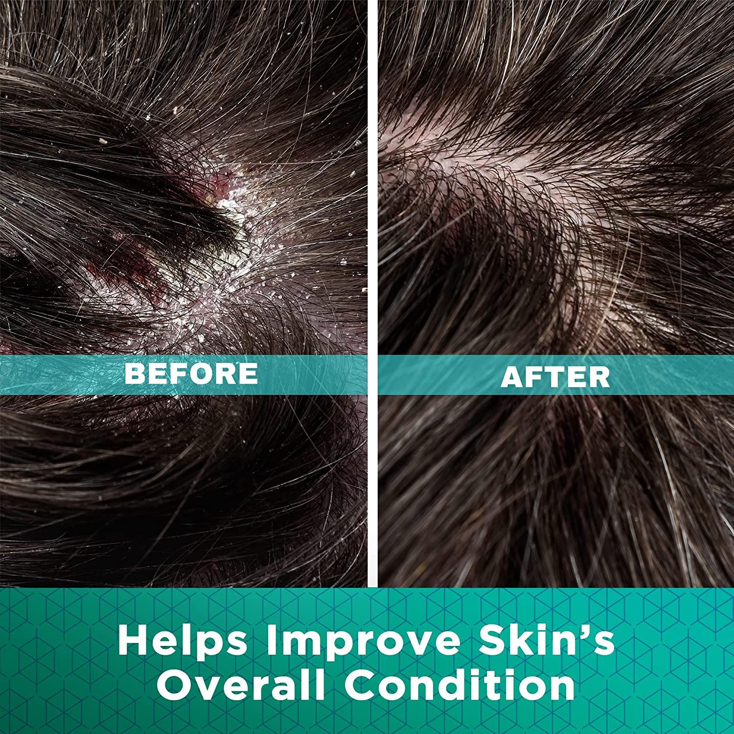 Dermoscribe Seborrheic Dermatitis & Eczema Cream FastActing Itchy