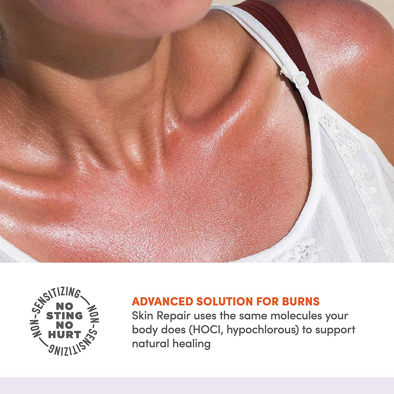 Active Skin Repair Burn Hydrogel - First Aid With Hypochlorous Acid For Immediate Pain Relief (3oz, HSA/FSA)