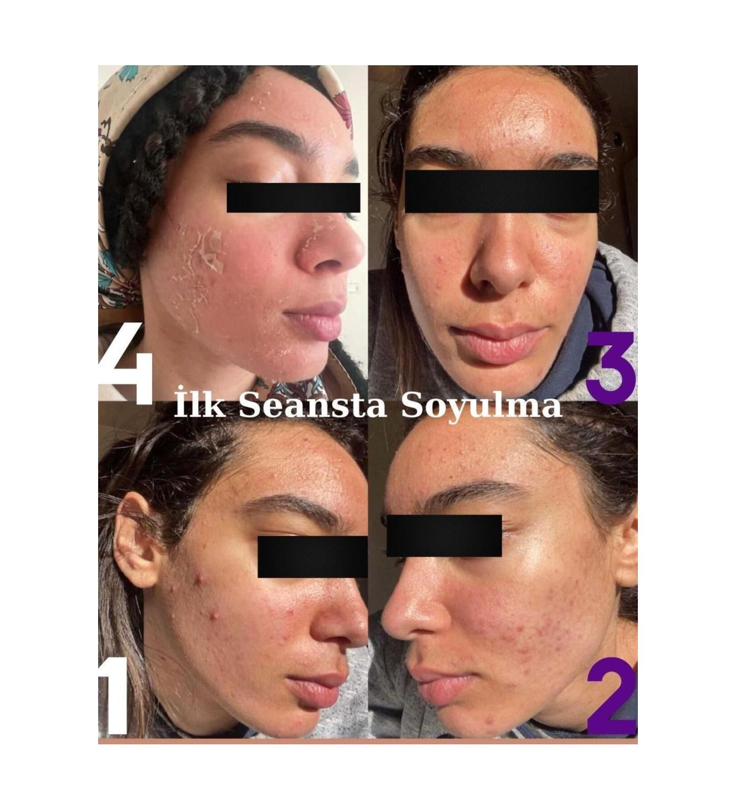 DR.ALGLER Algae Peeling Professional 5 Uses - Buy Online on GoSupps.com