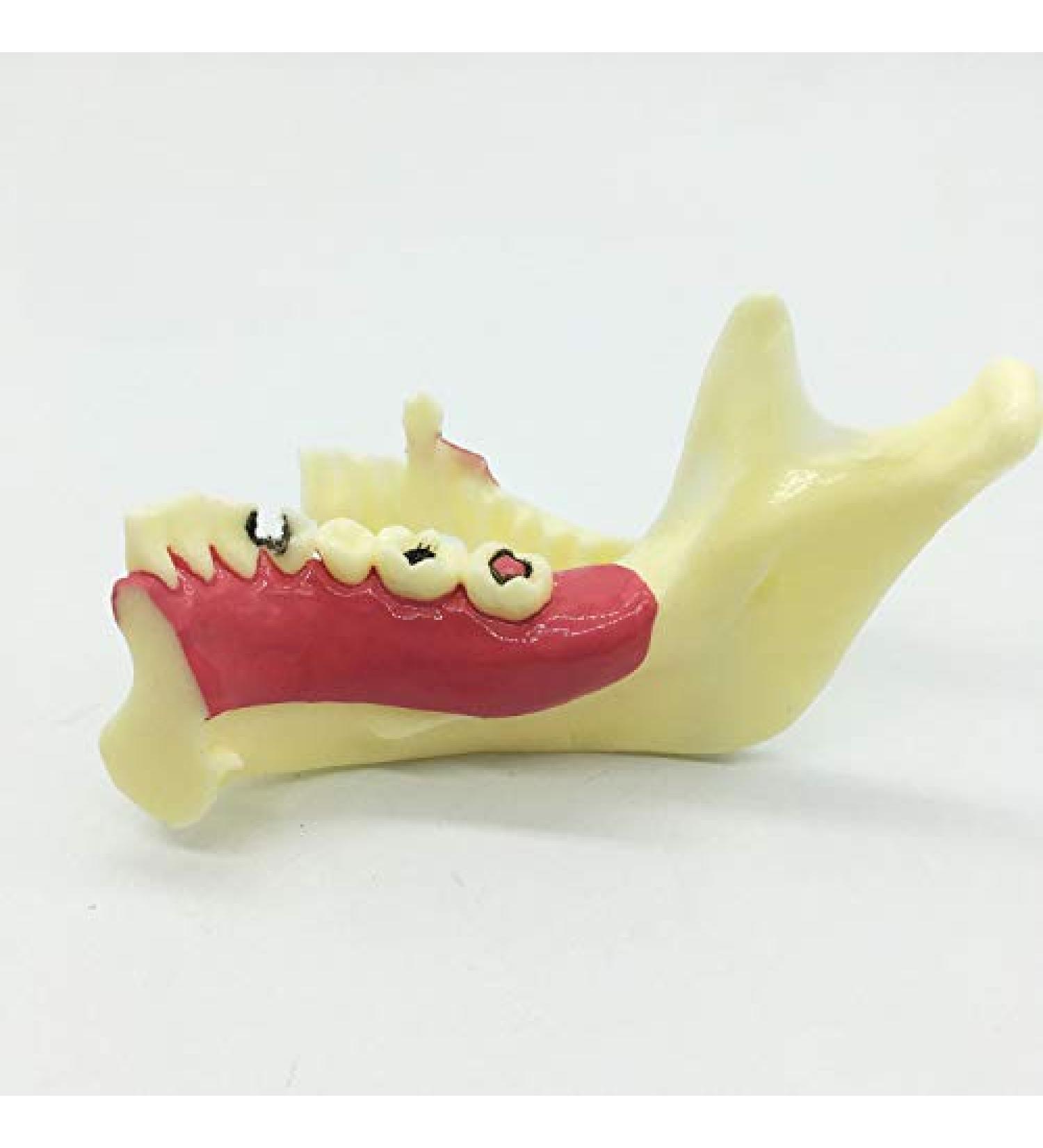 Ernzi Lower Jaw Decomposition Model - Realistic Dental Simulation & Teaching Tool for Oral Health Education - Buy Online on GoSupps.com