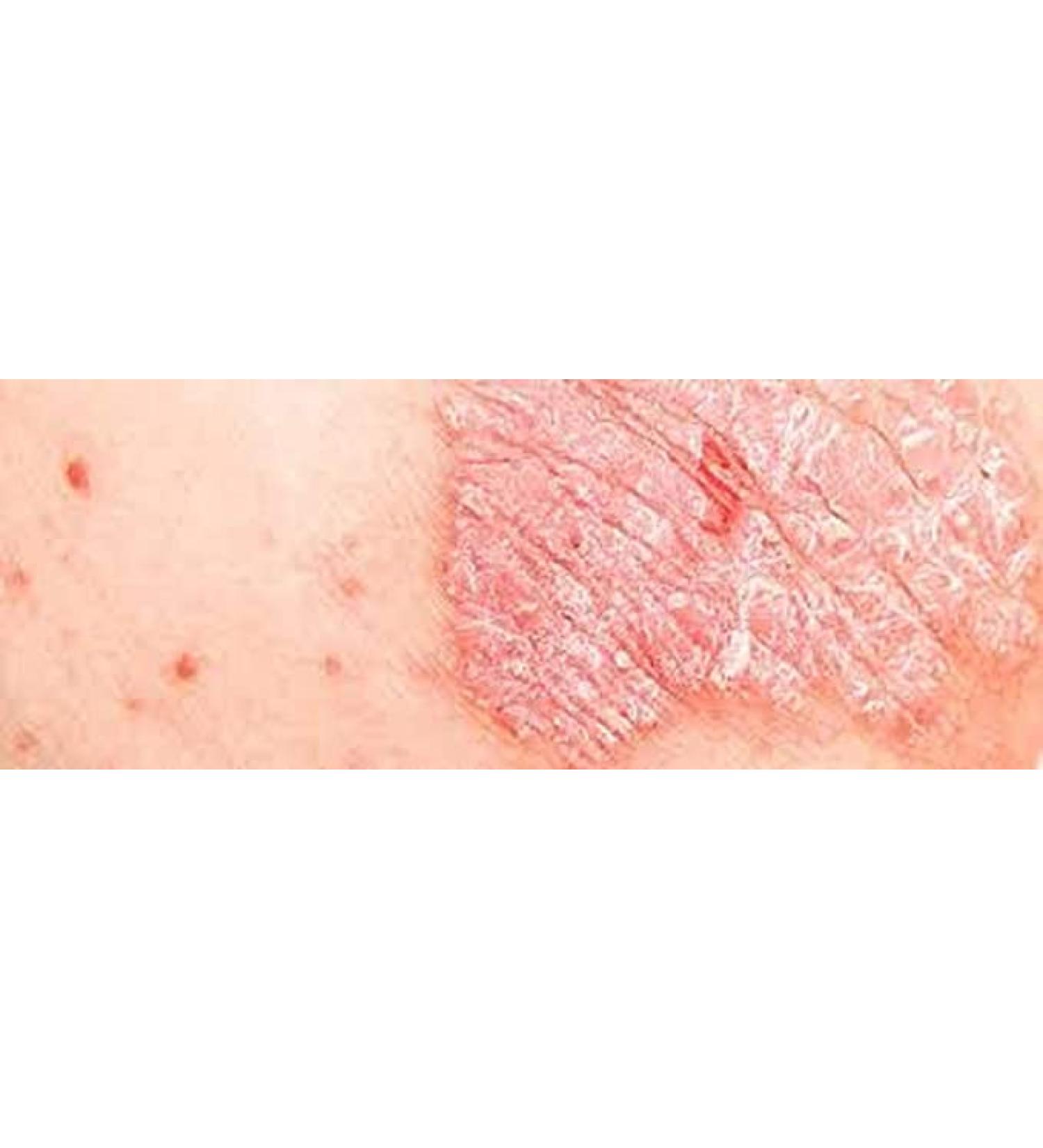 ROSEVILLA Zyrex Psoriasis Nill Tablets -60 Tablets for Cleaning Psoriasis for Body Permanently Best for All Ages Men & Women. 100% Herbal Tablets