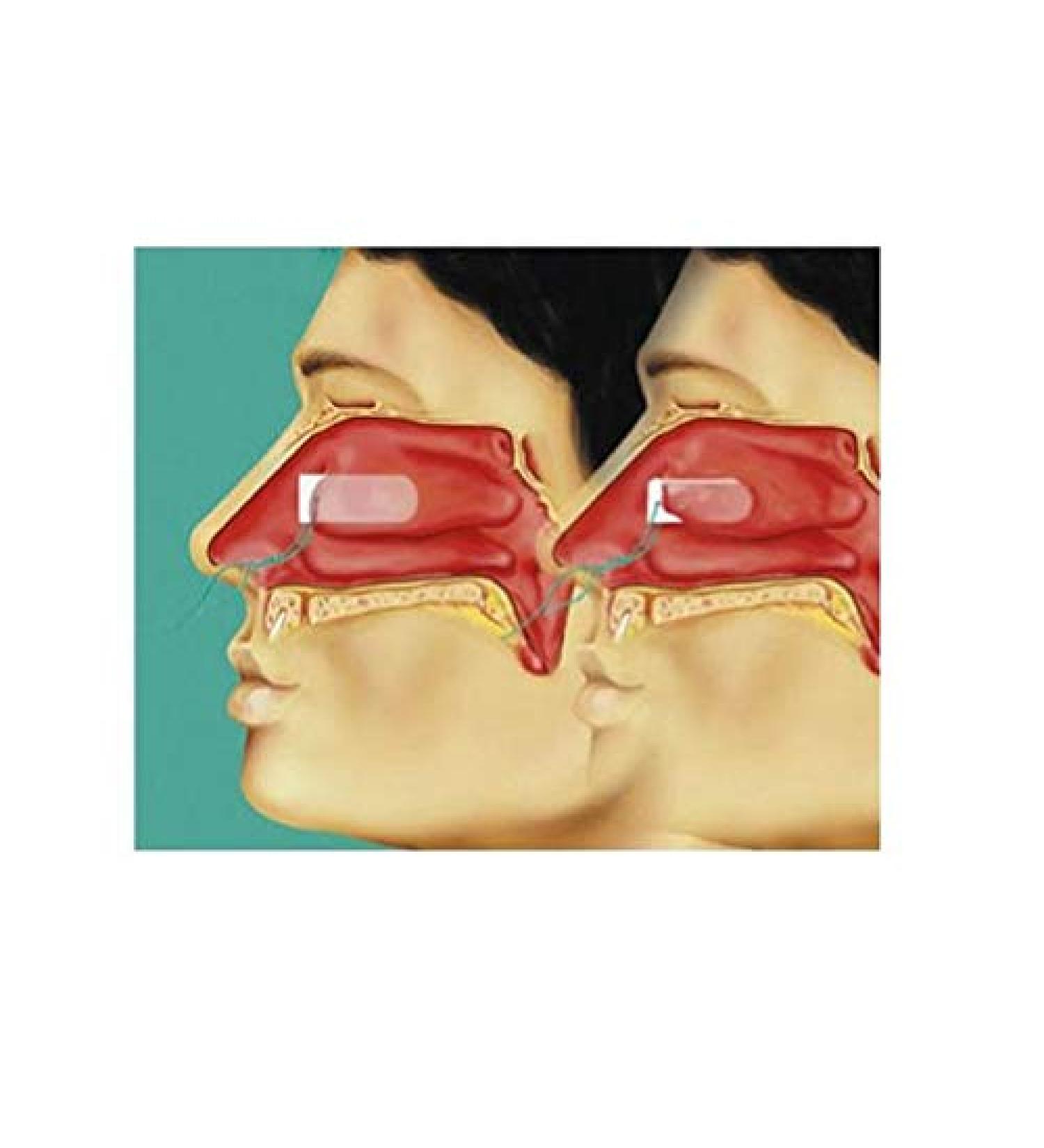 Raucoccel sinus tamponade K sterile 35 mm 20 pieces