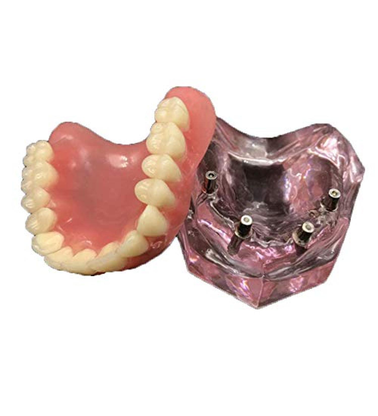 Vinbcorw Dental Model - Maxilla Mini 4 Implant Screws for Mobile Prosthesis Repairs | Removable Pink Design - Buy Online on GoSupps.com