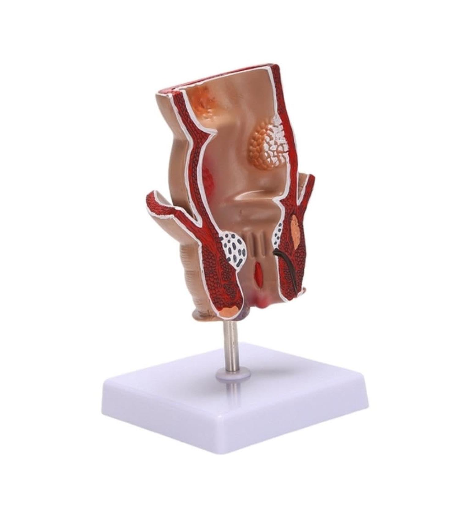 for Anatomy Model Human Rectal Hemorrhoid Lesion Model Hemorrhoid Fistula Fistula Fissure Pathology Teaching Model