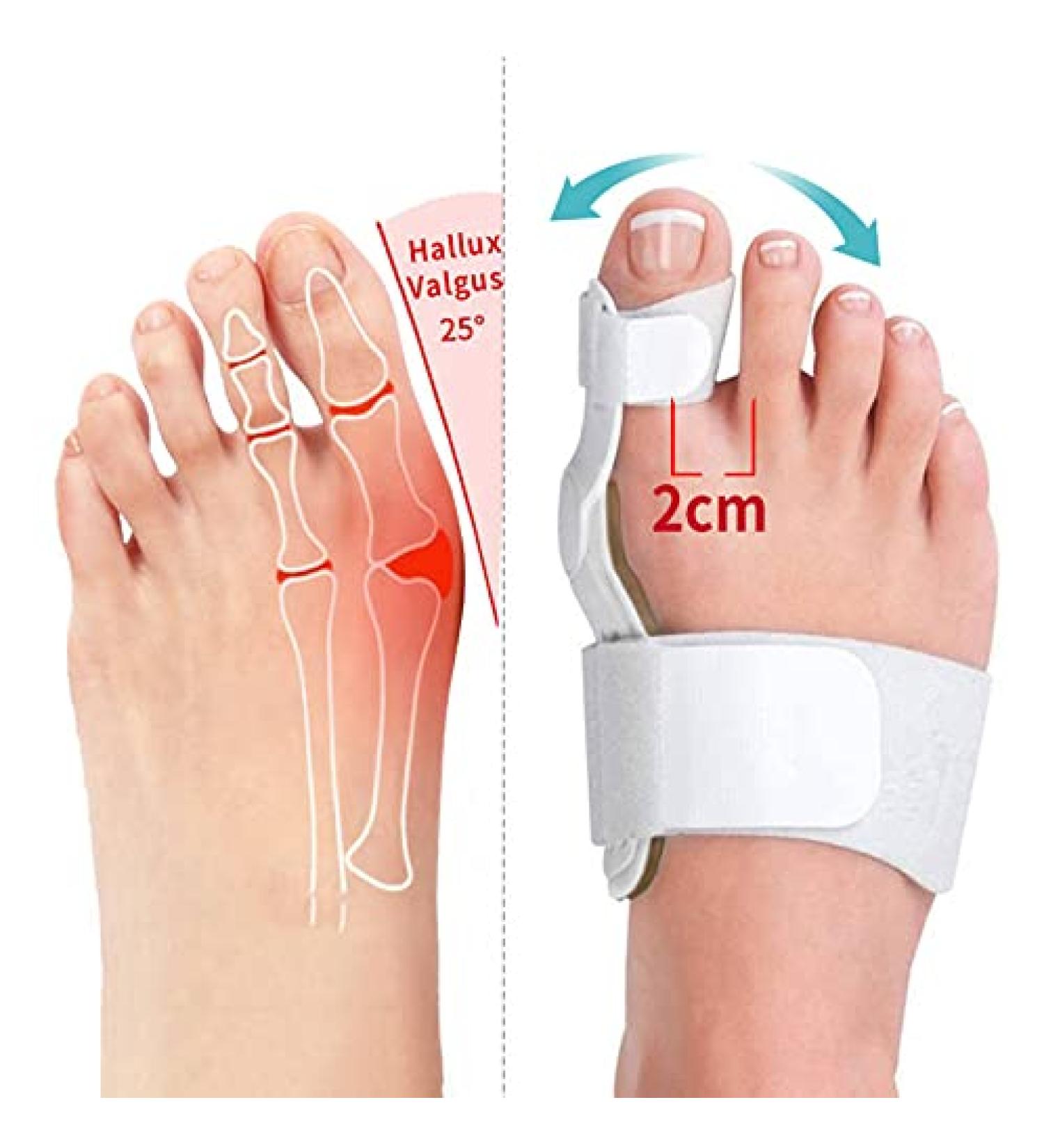 Best Bunion Corrector - Orthopedic Splint for Hallux Valgus & Hammer Toe - Men & Women Night Use - Buy Online on GoSupps.com