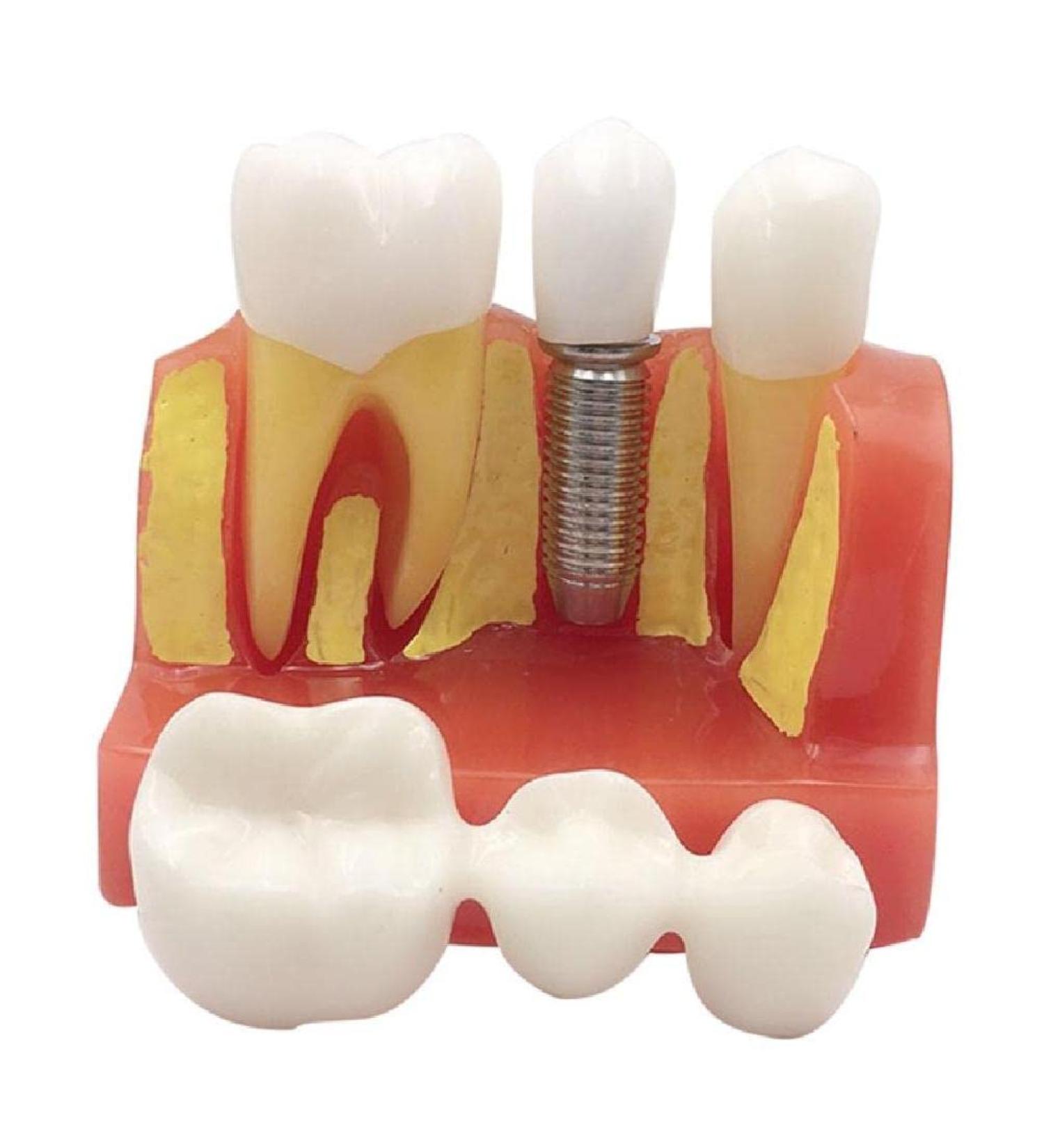 4x Dental Implant Teeth Model with Removable Crown - Crown & Bridge Dentist Training Tool for Patient Analysis | International Shipping - Buy Online on GoSupps.com