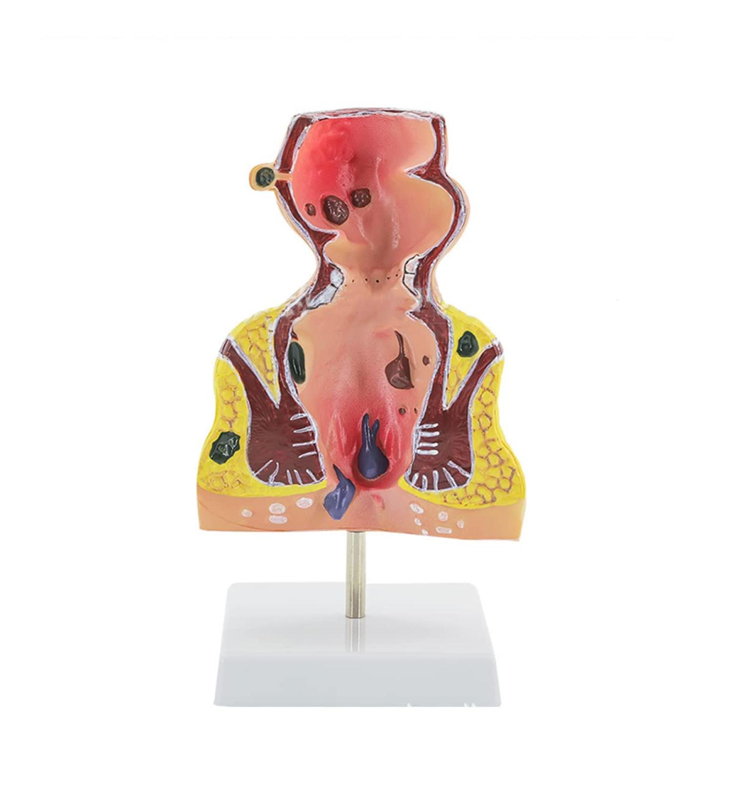 Human Anorectal Pathology Model Hemorrhoid Lesion Model Hemorrhoid Anal Fistula Lesion Model Rectal Medical Education/Product Education - Buy Online on GoSupps.com