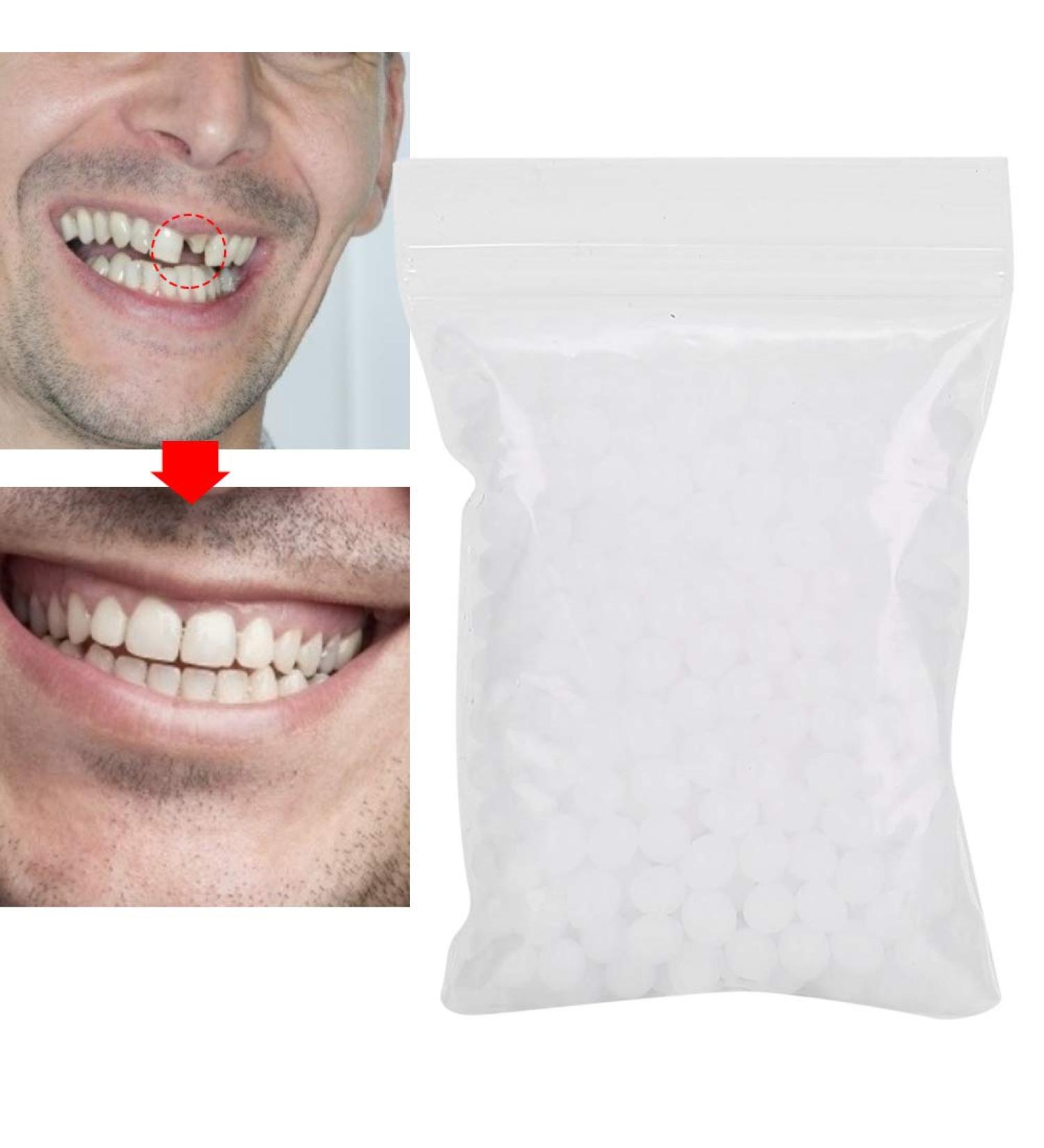 Temporary Tooth Repair Beads - Fix Missing or Broken Teeth - 20g Set - Buy Online on GoSupps.com