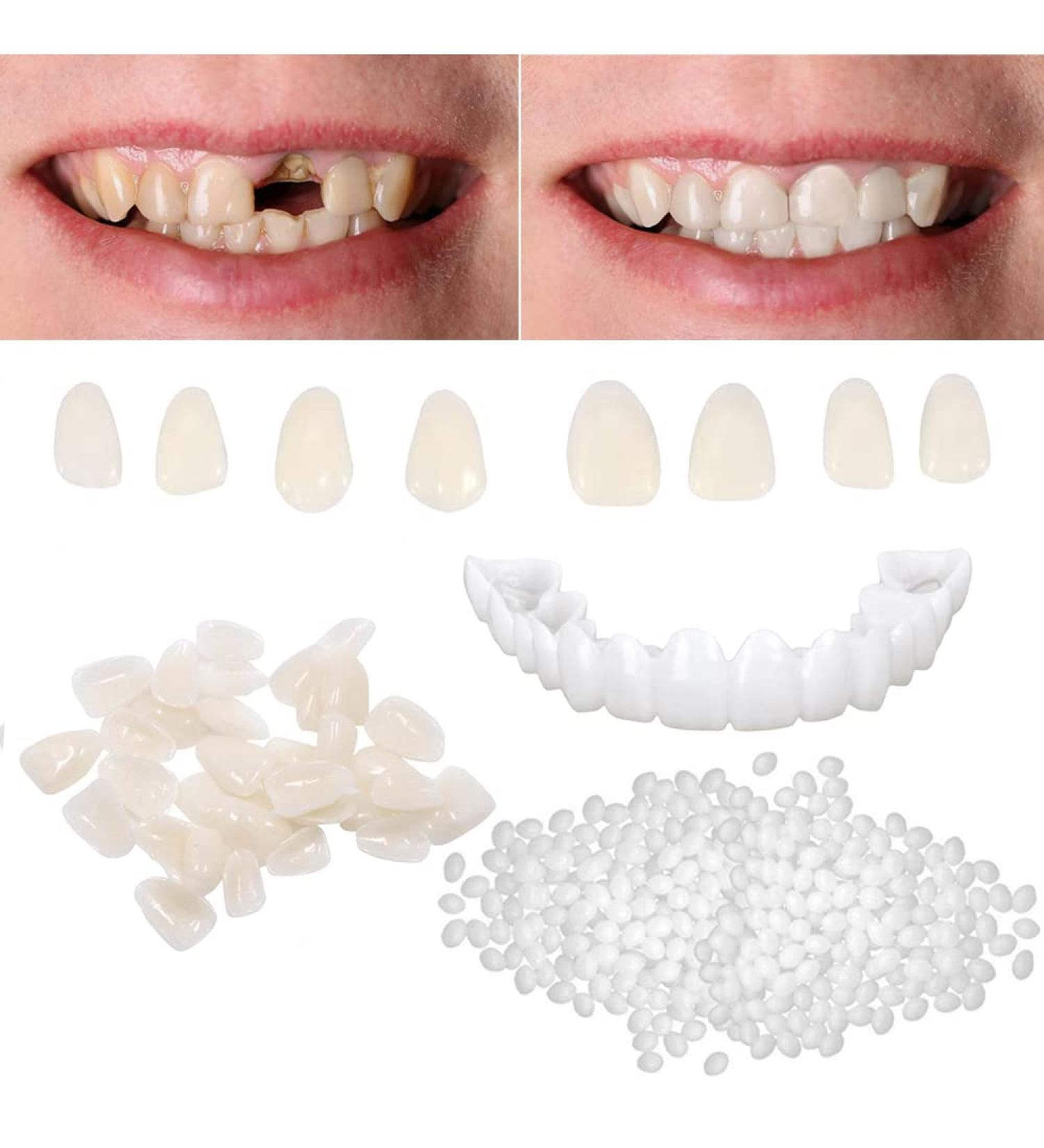 Tooth Repair Kit: Temporary Fix for Missing, Chipped, Broken Teeth - Thermal Beads & Brace Mold Included - Buy Online on GoSupps.com