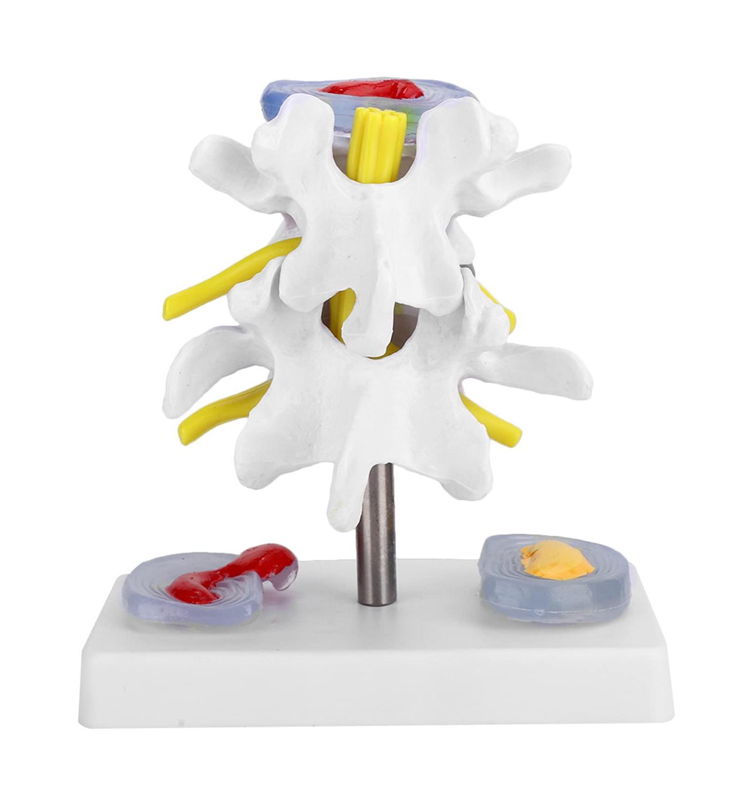 Anatomical Lumbar Intervertebral Disc Model - Spine Demonstration for Training & Education | International Shipping Available - Buy Online on GoSupps.com