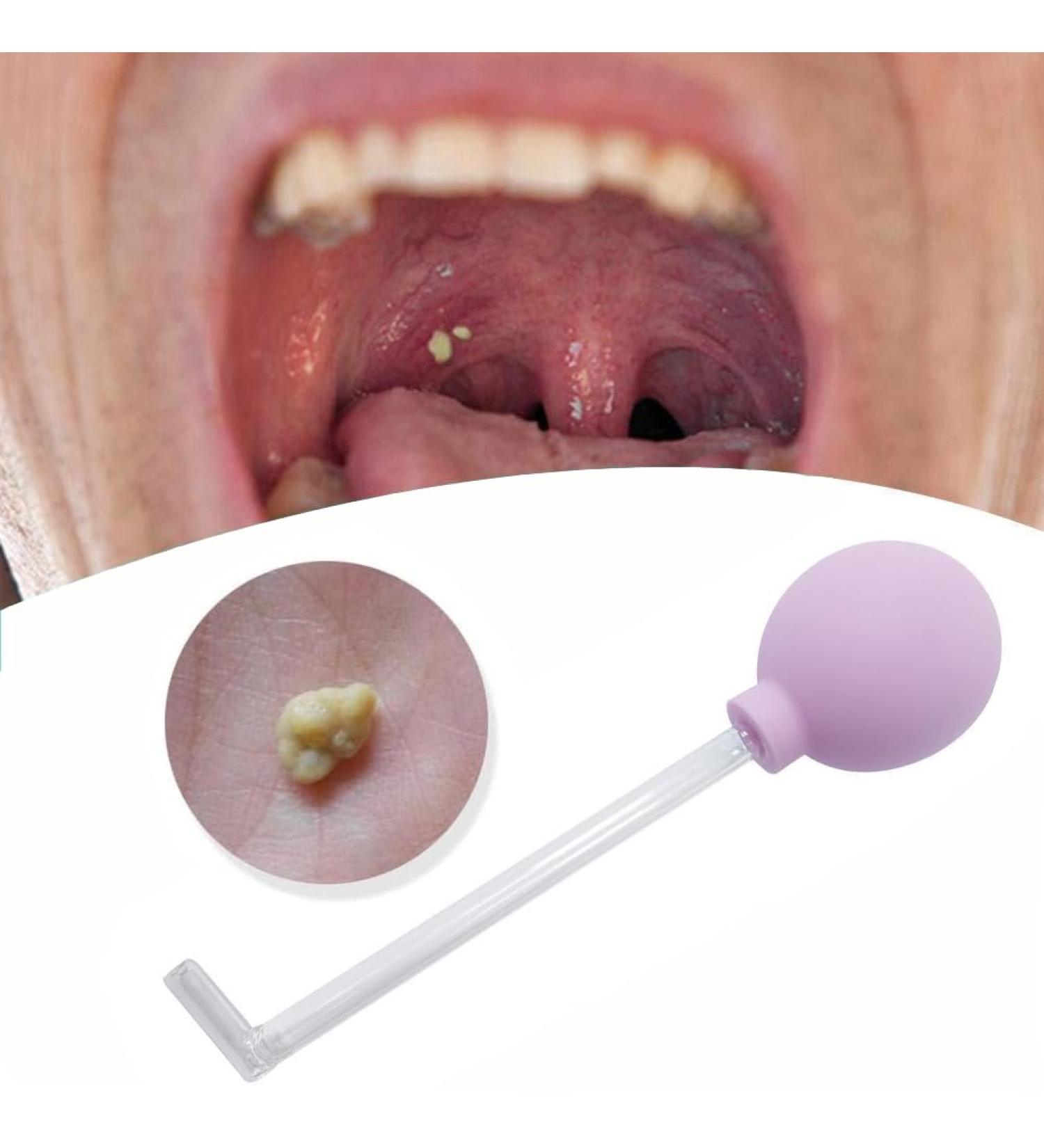 Portable Tonsil Stone Remover Kit - Oral Suction Tool for Adults (Purple) - Buy Online on GoSupps.com