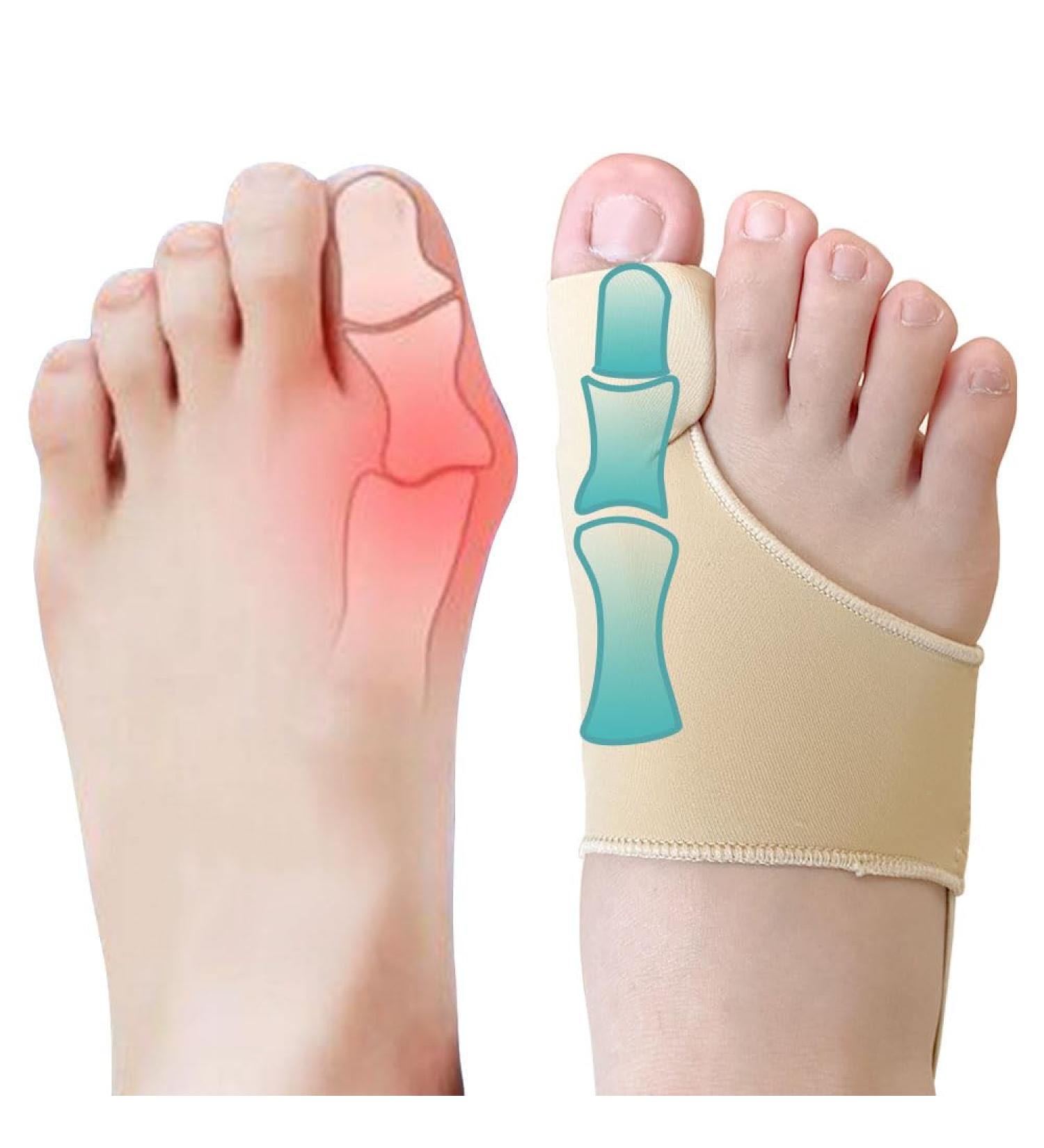 Bunion Sleeves Corrector for Men & Women - Big Toe Straightener Hallux Valgus Splint | Gel Pads & Foot Care Kit for Pain Relief (Beige - Buy Online on GoSupps.com