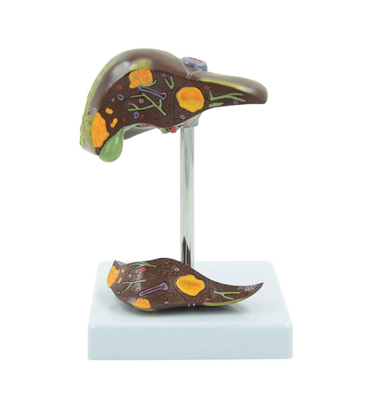 Liver Pathology Model Fatty Cirrhosis Carcinoma Demonstration Model Shows 7 Liver Diseases Detachable 2 Parts for Doctors Office Educational Tool - Buy Online on GoSupps.com