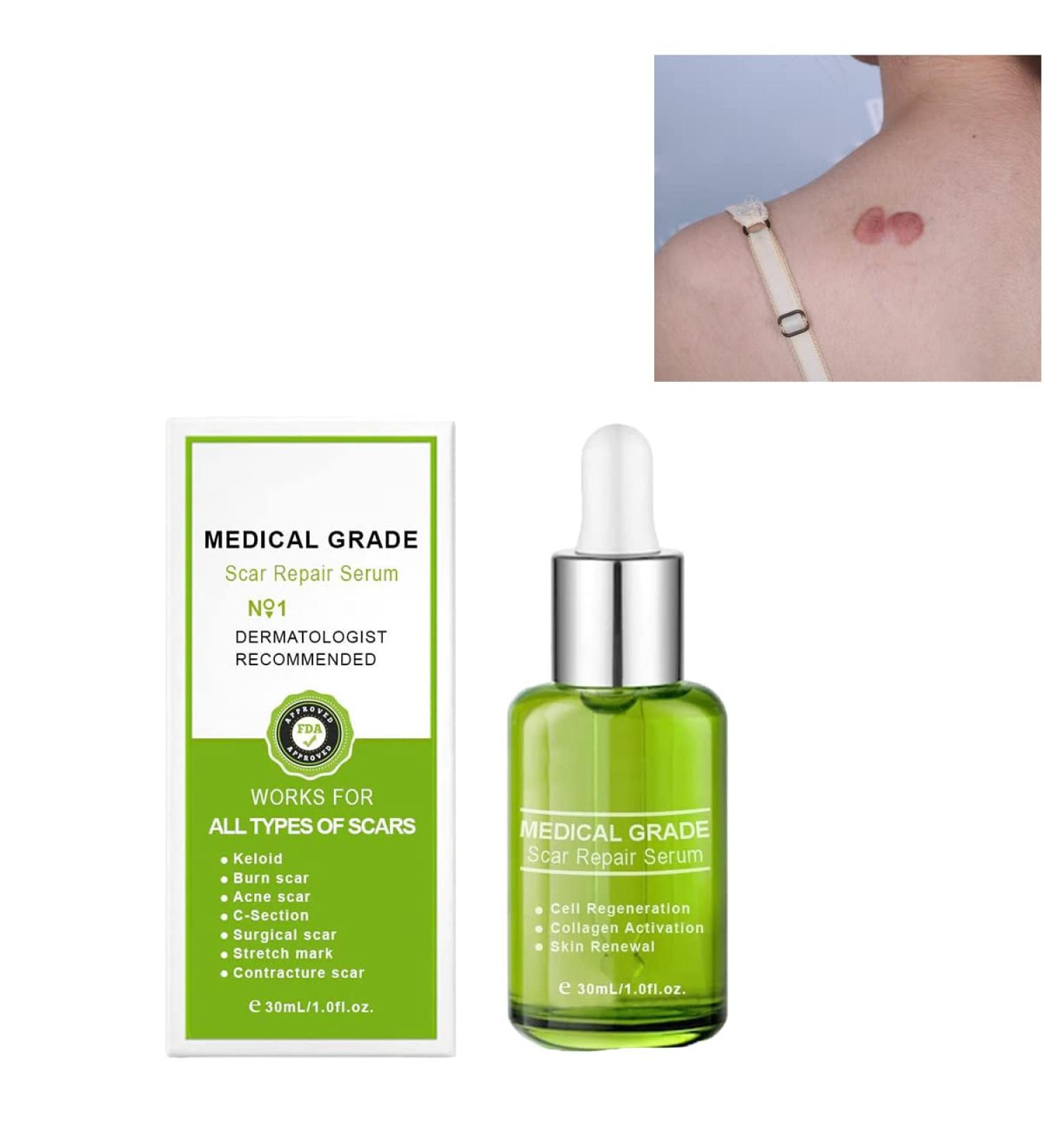 Proregen Medical Grade Scar Removal Spray - Advanced Serum for All Types of Scars (1PCS) - Buy Online on GoSupps.com