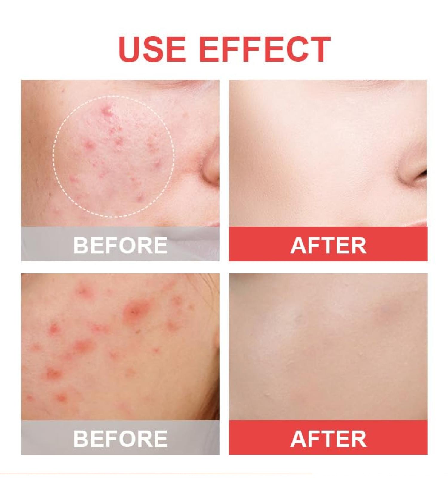 Buy Hydrocolloid Pimple Patches - Acne & Blemish Covers for Clear Skin | International Shipping Available - Buy Online on GoSupps.com