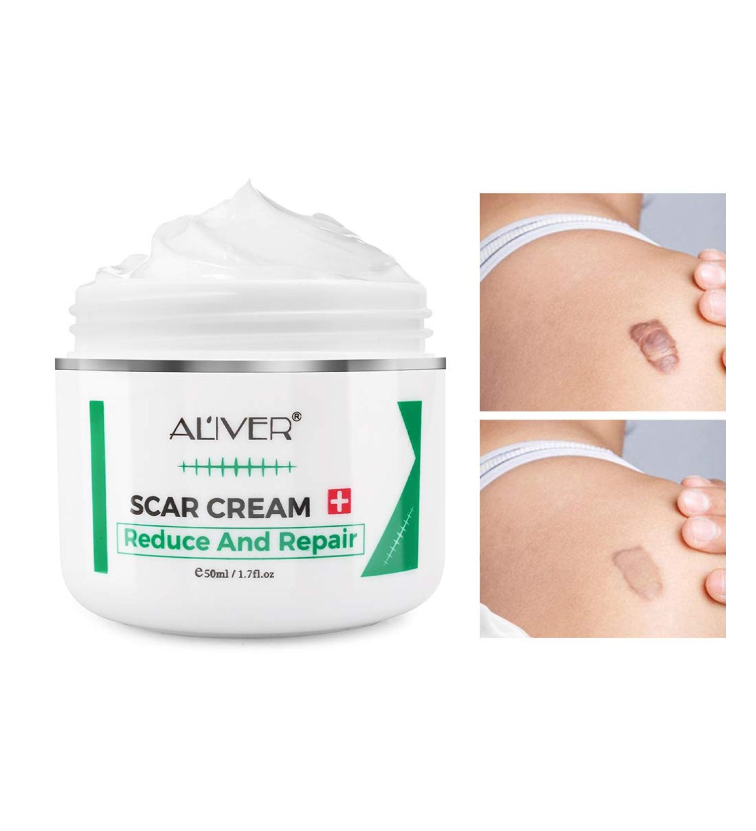 Scar Removal Cream for Old Scars, Stretch Marks & Burns - Natural Skin Repair for Acne Scars & Spots - Buy Online on GoSupps.com