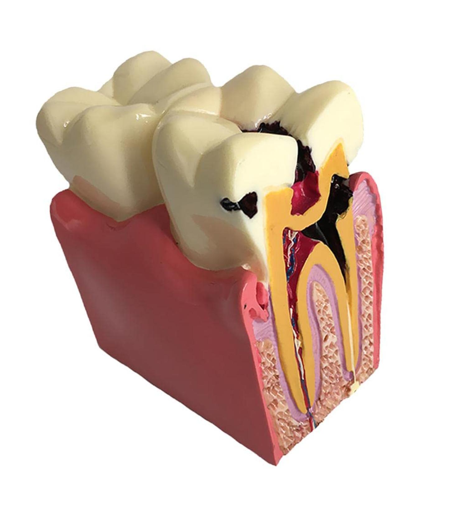 Colcolo Teeth Model - 6X Caries Comparison Examination Models for Study & Research | International Shipping Available - Buy Online on GoSupps.com