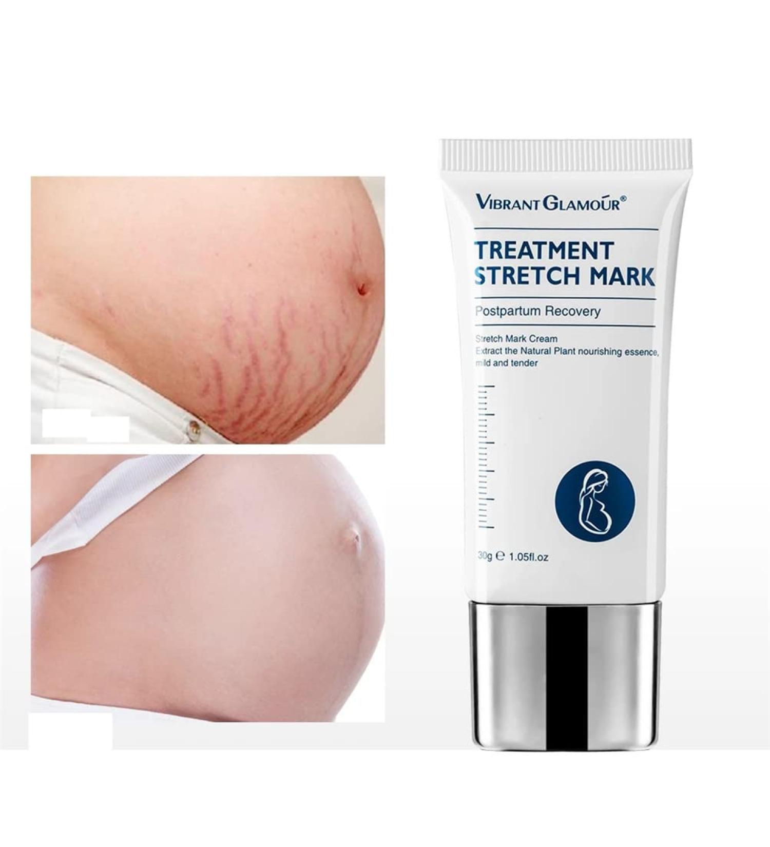 Stretch Mark Removal Acne Scar Stretch Fat Striae Gravidarum Treatment Repair Anti-Aging Angles Firming Body Care (2 Pack) - Buy Online on GoSupps.com
