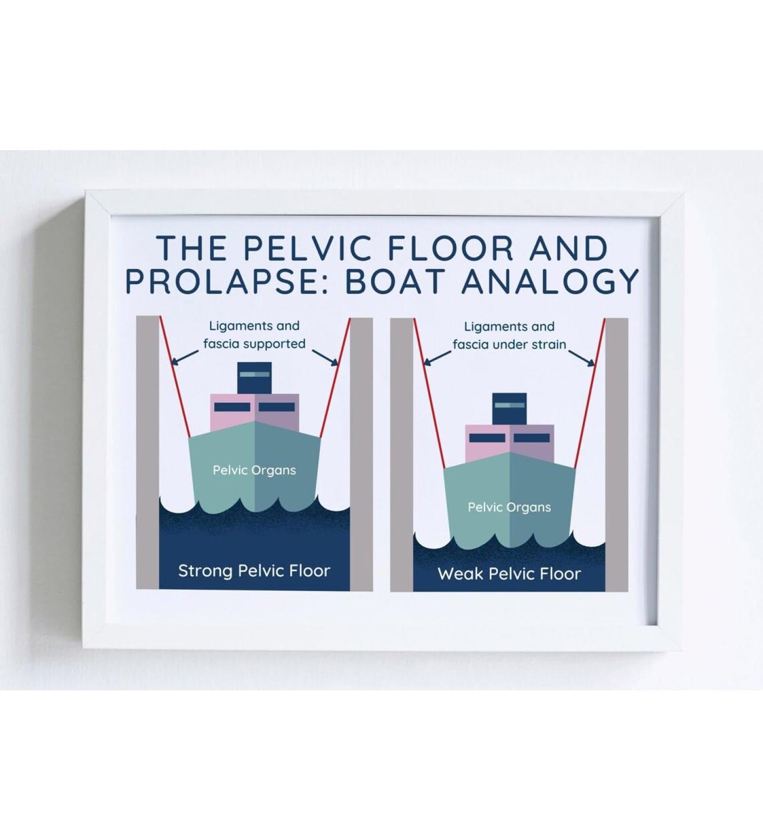 Pelvic Floor Physical Therapist Poster | Women's Health | Prolapse & Therapy Art | Canvas & Prints for eCommerce - Buy Online on GoSupps.com