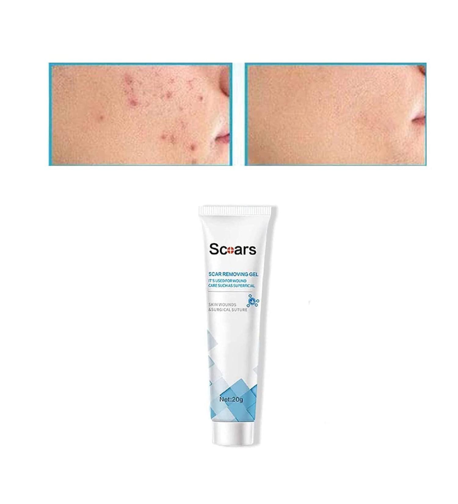PICKX Organic Scar Removing Gel - Keloid & Surgical Scar Removal Cream - Lightens Scars and Acne Marks - Gentle on Sensitive Skin (1PC) - Buy Online on GoSupps.com
