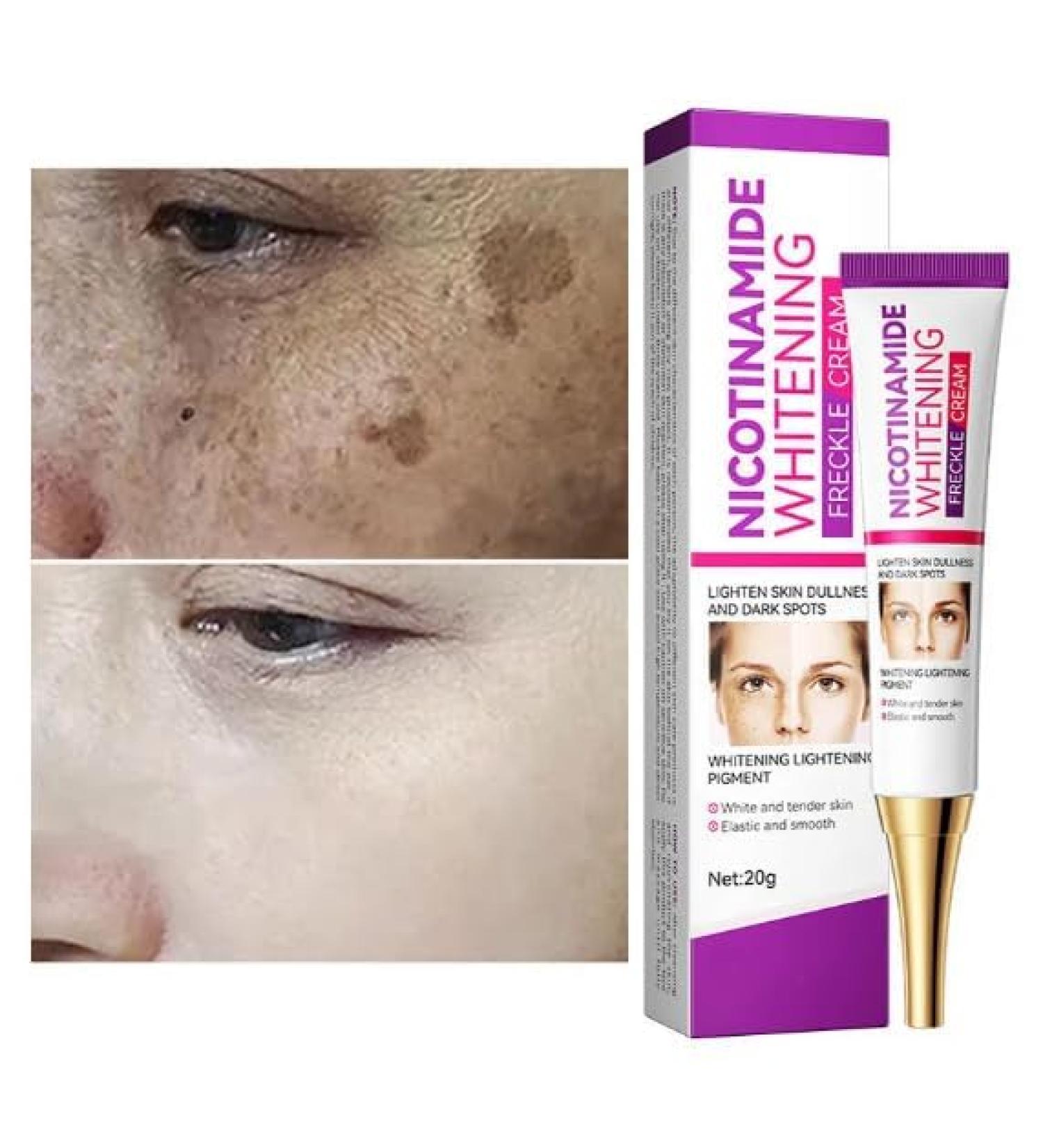 Cremas Para Las Manchas de La Cara Oscuras Para Eliminar Manchas en la Cara Crema Para Quitar Manchas de la Cara Crema Blanqueadora Para Pecas - Buy Online on GoSupps.com