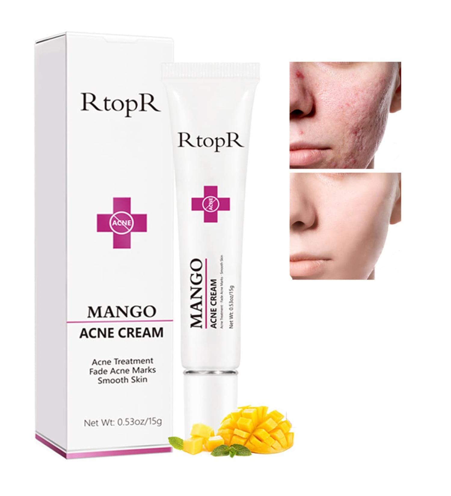Easilydays Mango Acne Cream: Pimple & Scar Treatment for Moisturized Skin, Pore Reduction & Acne Scar Removal - Balances Water & Oil - Buy Online on GoSupps.com