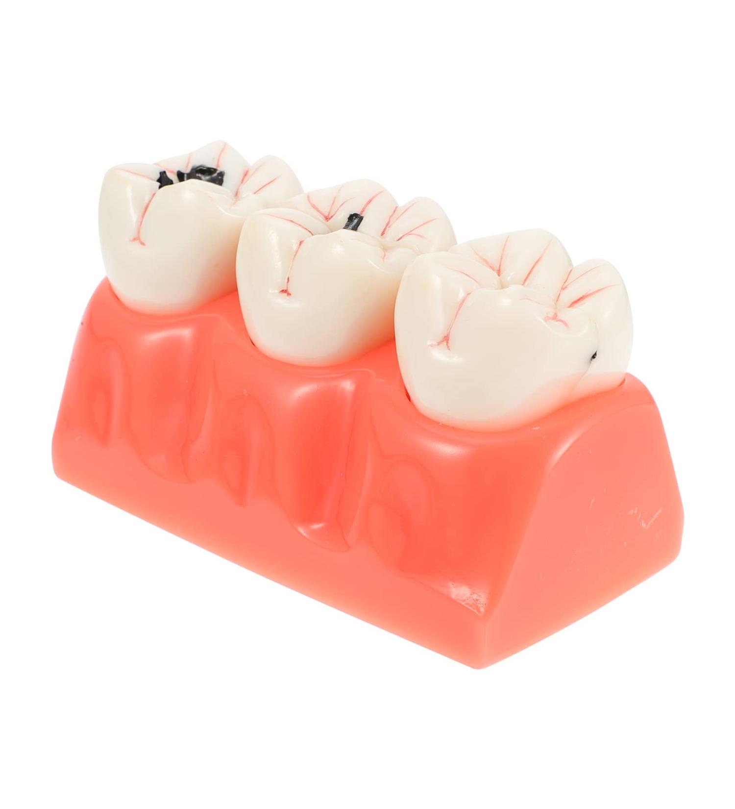 Ultechnovo Dental Recovery Tool Set - 2 Caries Tooth Models for Teaching & Demonstration | 12.5x7x6.5cm - Ideal for Dentistry Education - Buy Online on GoSupps.com