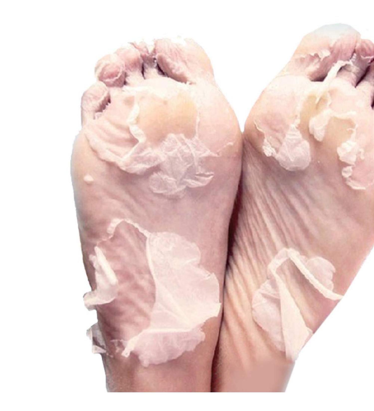 Onkessy Foot Peel Mask - Exfoliating Dead Skin Feet Repair Treatment - For Men and Women - Pedicure Spa - 1 Pair - Buy Online on GoSupps.com