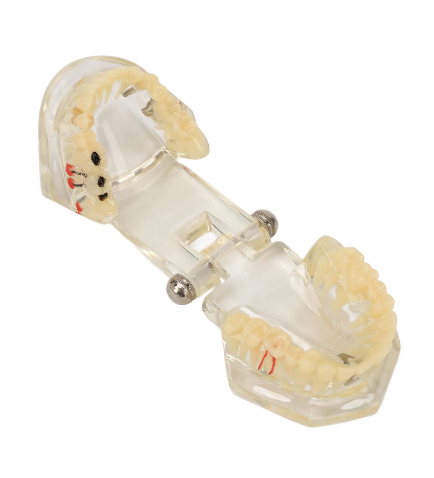 Buy Verdant Touch Transparent Dental Implant Model - Ideal Teaching Aid for Pathology & Dental Studies | International Shipping Available - Buy Online on GoSupps.com