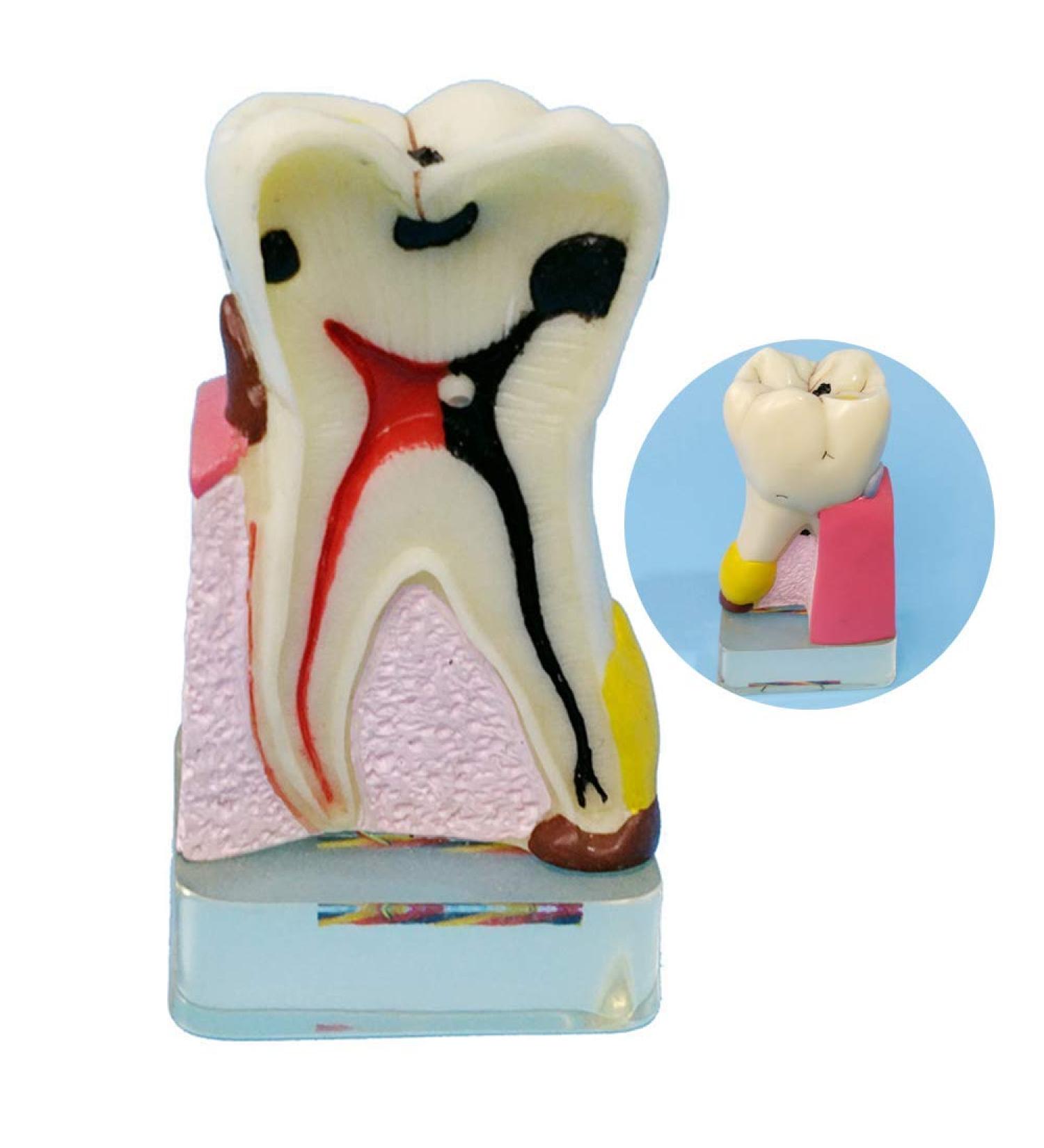 Dytah Dental Implant Model - Tooth Pathology & Crown Bridge Demonstration | Parodontal Sortal Teeth & Gums Educative Model for Dental Care - Buy Online on GoSupps.com