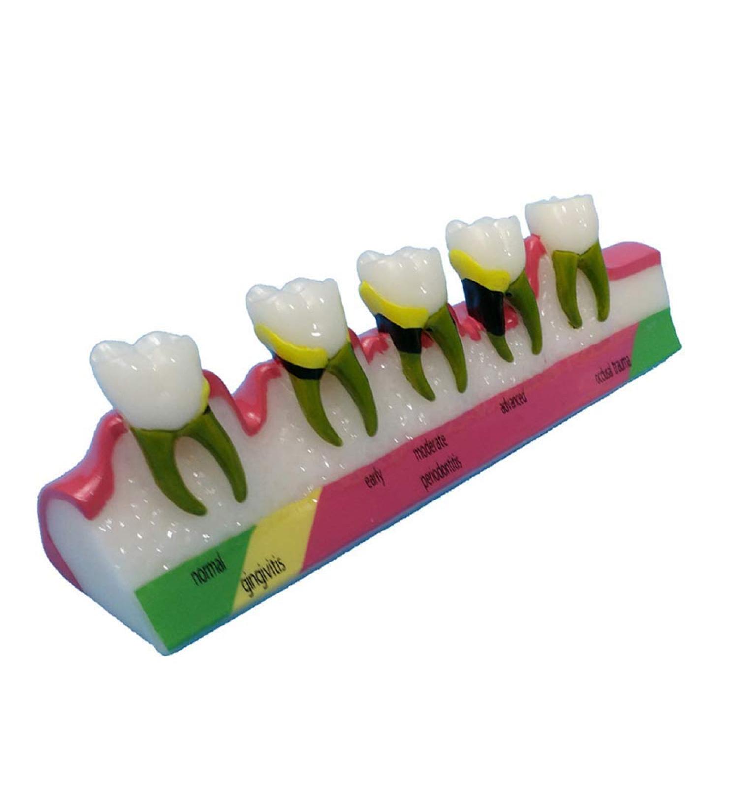 Dytah Dental Model - Adult Teeth Lessons for Periodontitis & Dental Disease Classification | Ideal for Teaching & Study - Buy Online on GoSupps.com