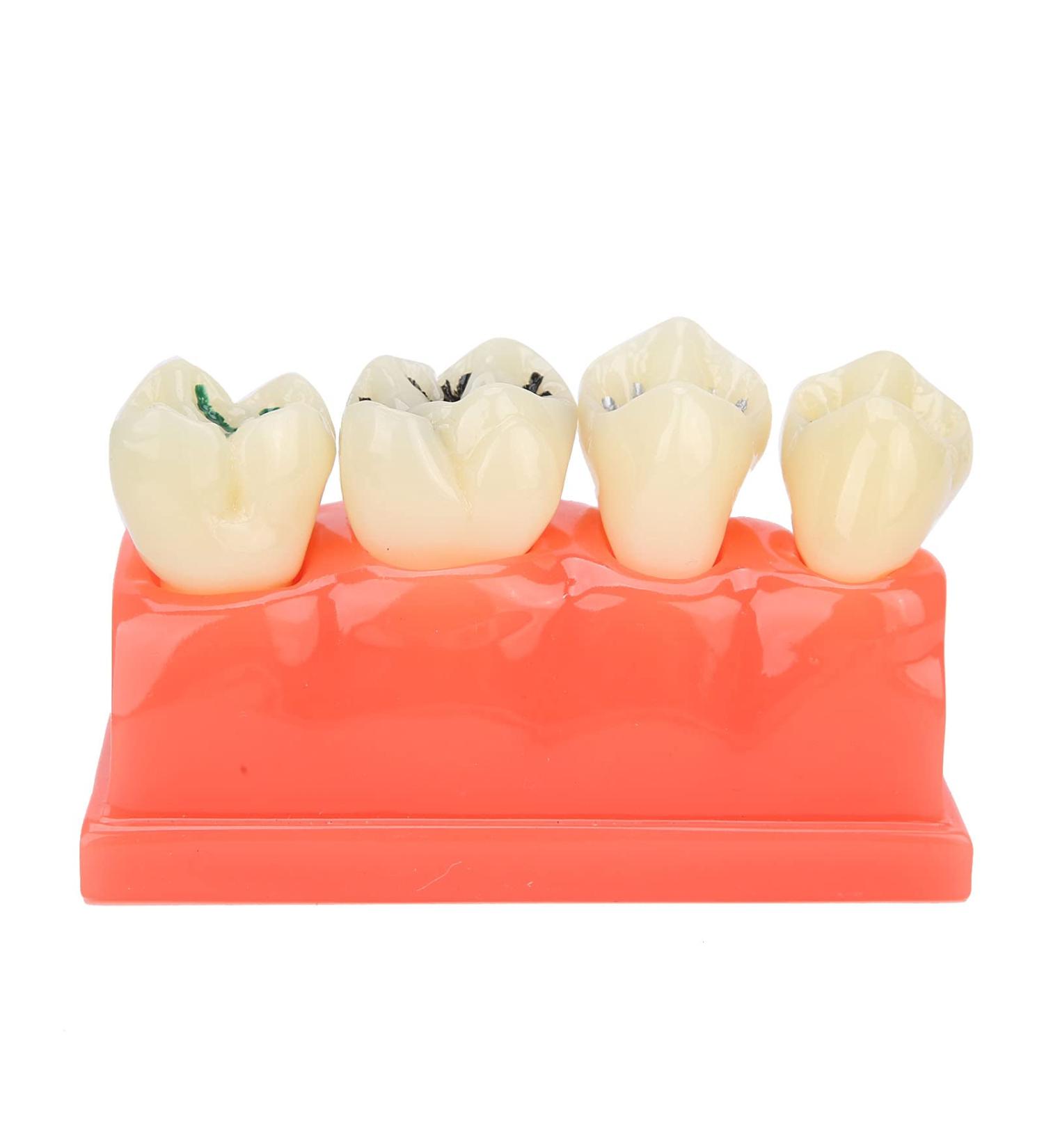 Ververt Touch Tooth Model - 180mm Dental Caries Demonstration Model for Schools & Dentists | Learning Aid for Dental Lessons - Buy Online on GoSupps.com