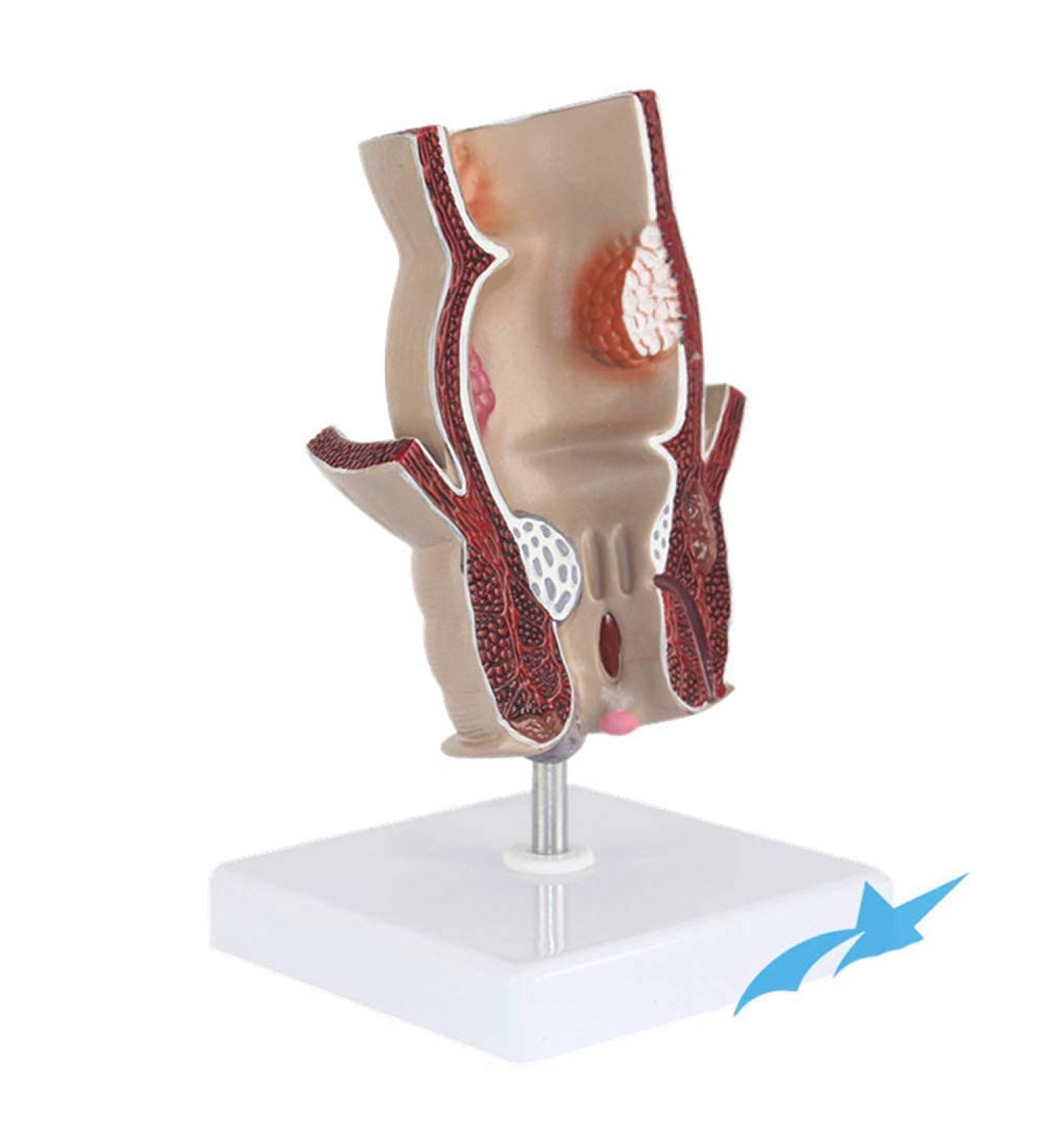 Rectum Model Human Pathological Diseases Rectum Ulcus Acne Pathological Model Use for Model Hemorrhoid Model Demonstration of Anorectal Diseases - Buy Online on GoSupps.com