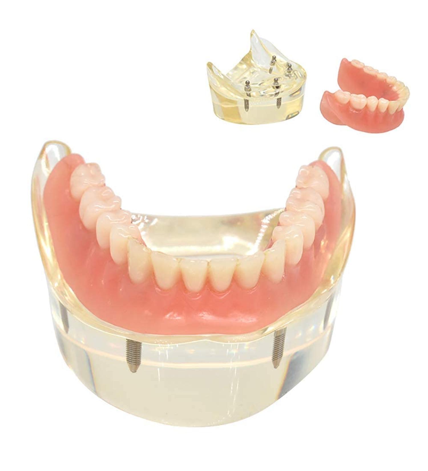 Dental Model Overdenture with 4 Implants - Ideal for Teaching Toothbrushing & Hygiene in Classes - International Shipping Available - Buy Online on GoSupps.com