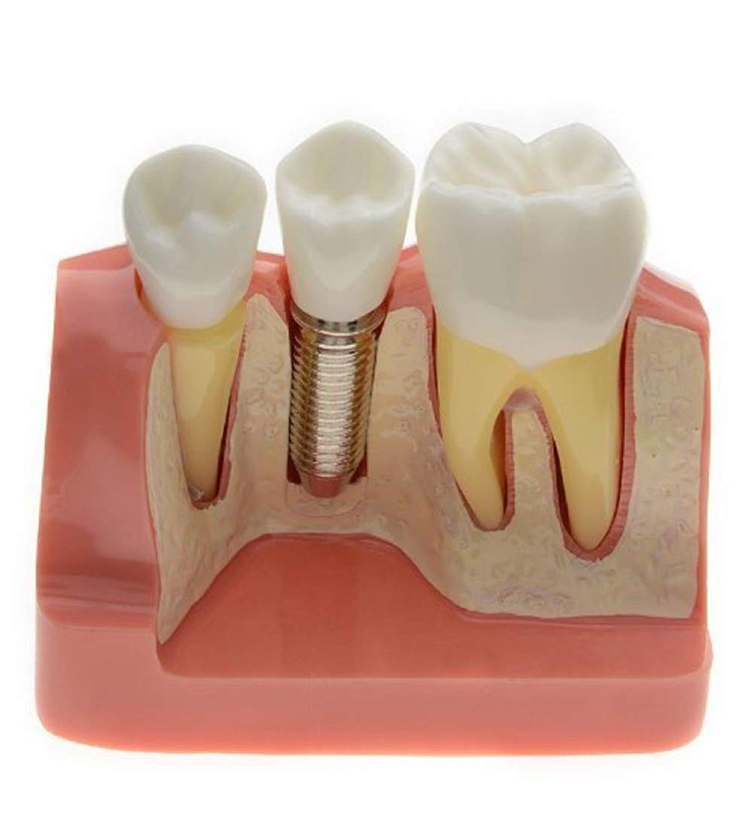 Dental Implant Analysis Demonstration Model - Crown Bridge Teeth Interpretation Model - Buy Online on GoSupps.com