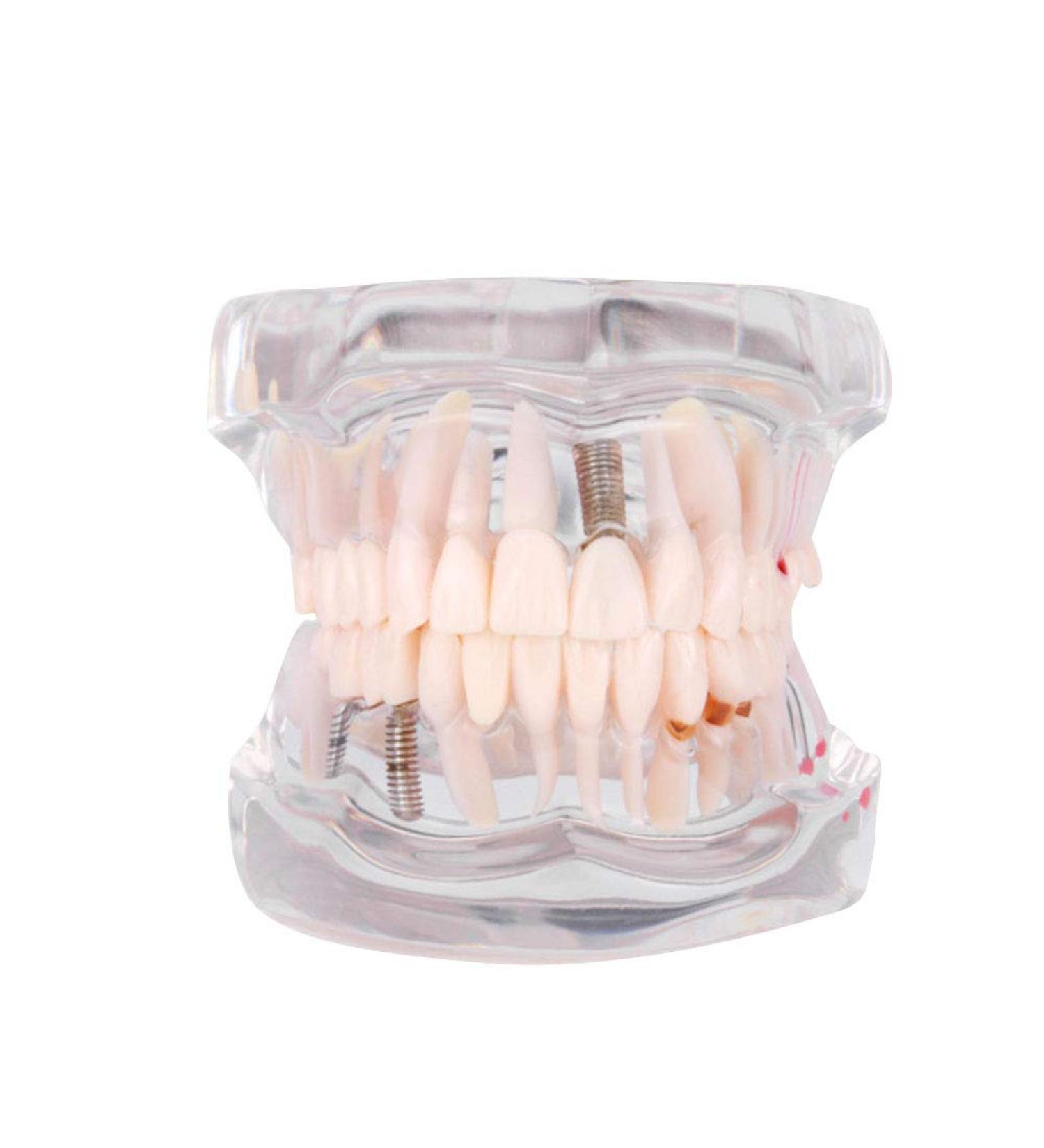 Cocoarm Removable Tooth Model - Dental Care Demo Tool for Teaching Study & Implant Education - Buy Online on GoSupps.com