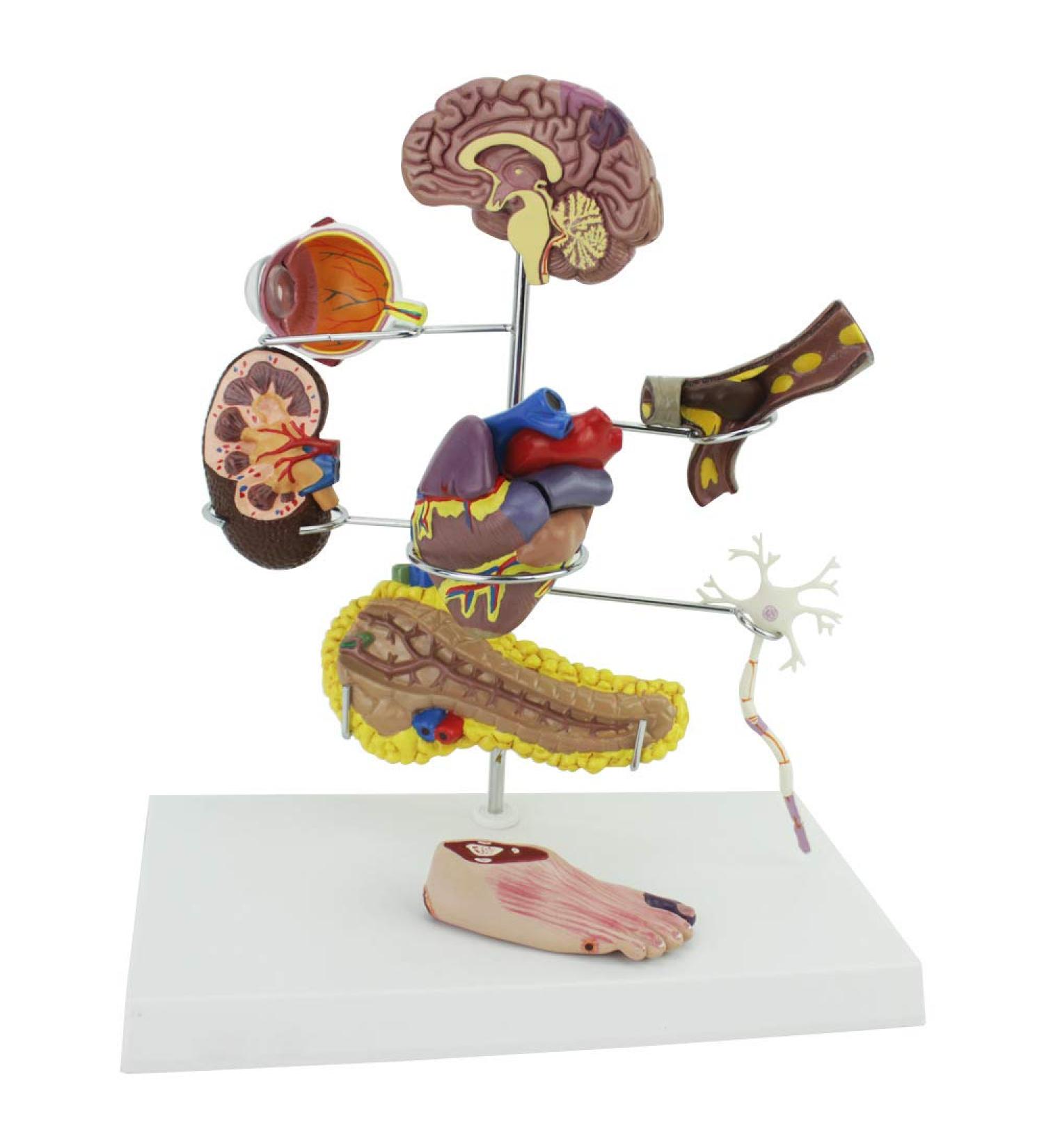 Uigjiog Human Diabetes & Cardiac Model - Coronary Thrombosis & Arterial Education Tool for Blood Vessels Brain Heart Pancreas and Foot Surgery - Buy Online on GoSupps.com