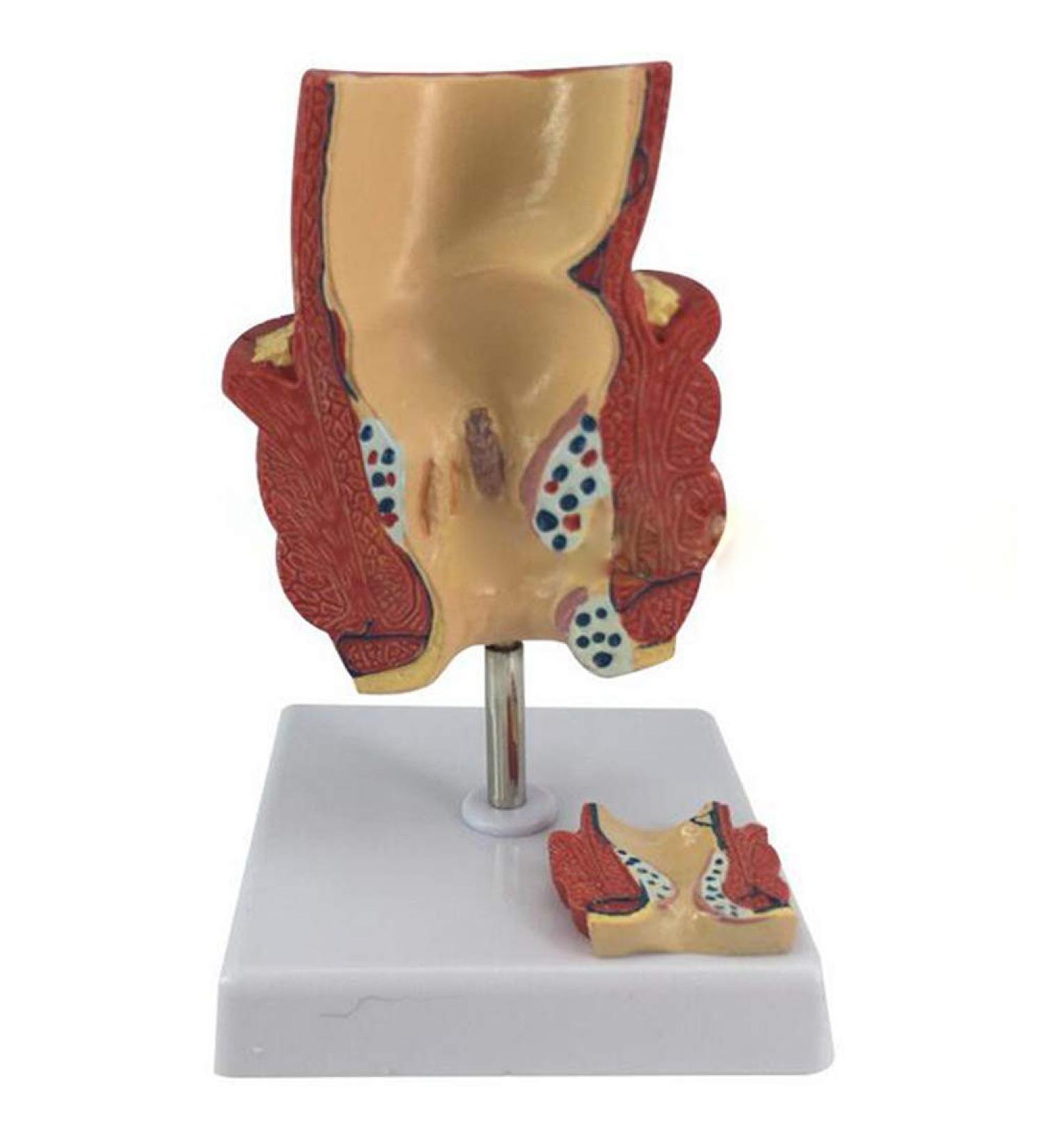 YOtat Human Pathological Hemorrhoids Model-Colorectal Hemorrhoid Lesion Model-Placed On The Base-is The Best Teaching Aid for Doctor-Patient Communication - Buy Online on GoSupps.com