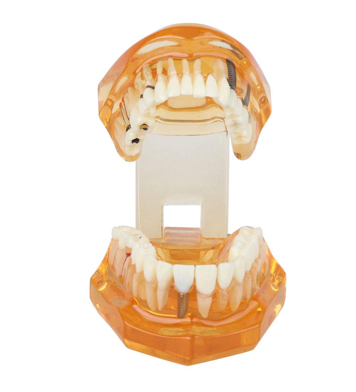 Standard Tooth Model - Removable Dental Teaching Materials for Kids & Adults | Typodont Demonstration Model - Buy Online on GoSupps.com