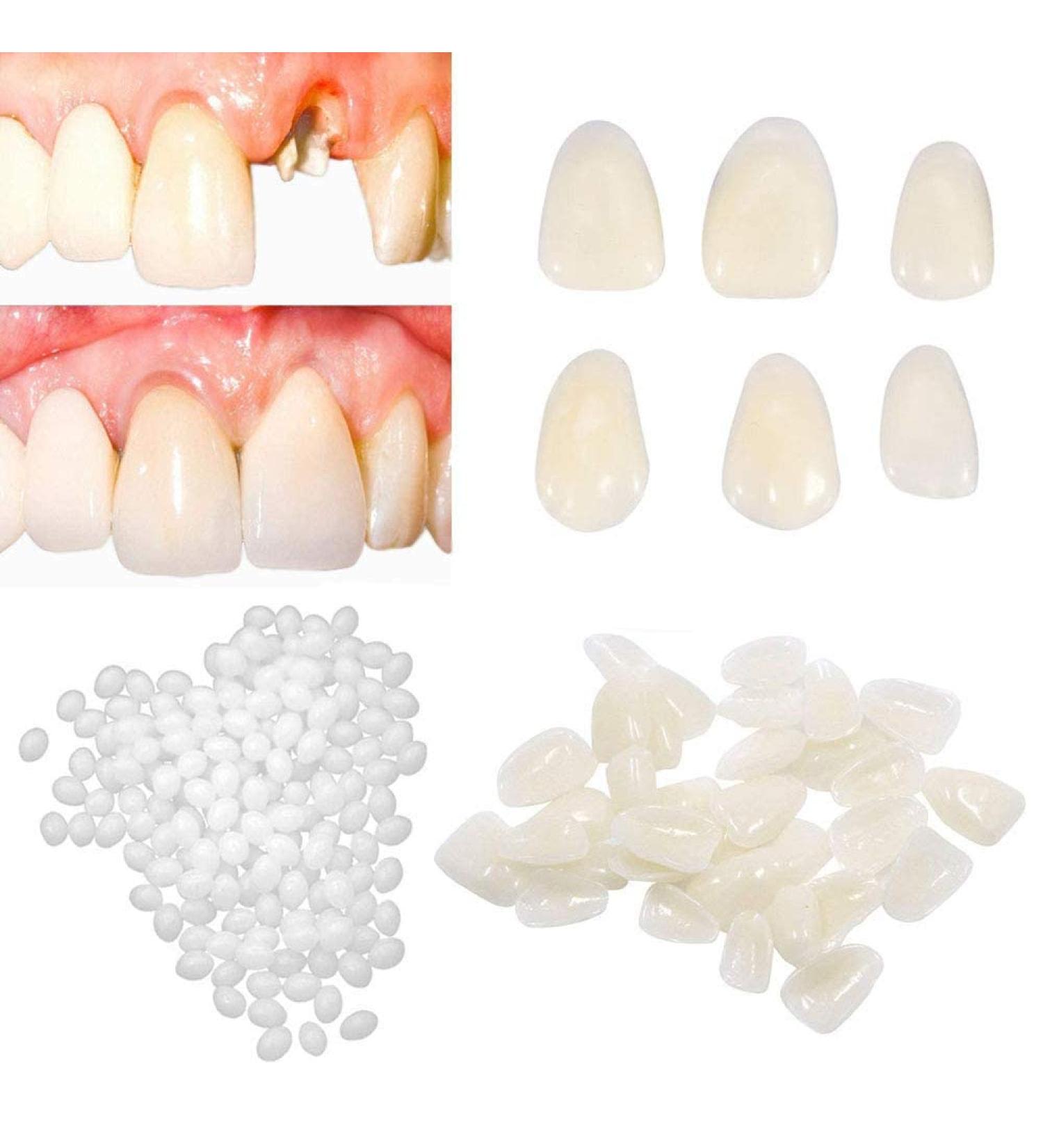 Temporary Tooth Repair Kit - Moldable Fake Teeth for Missing Broken Tooth and Gaps - Buy Online on GoSupps.com