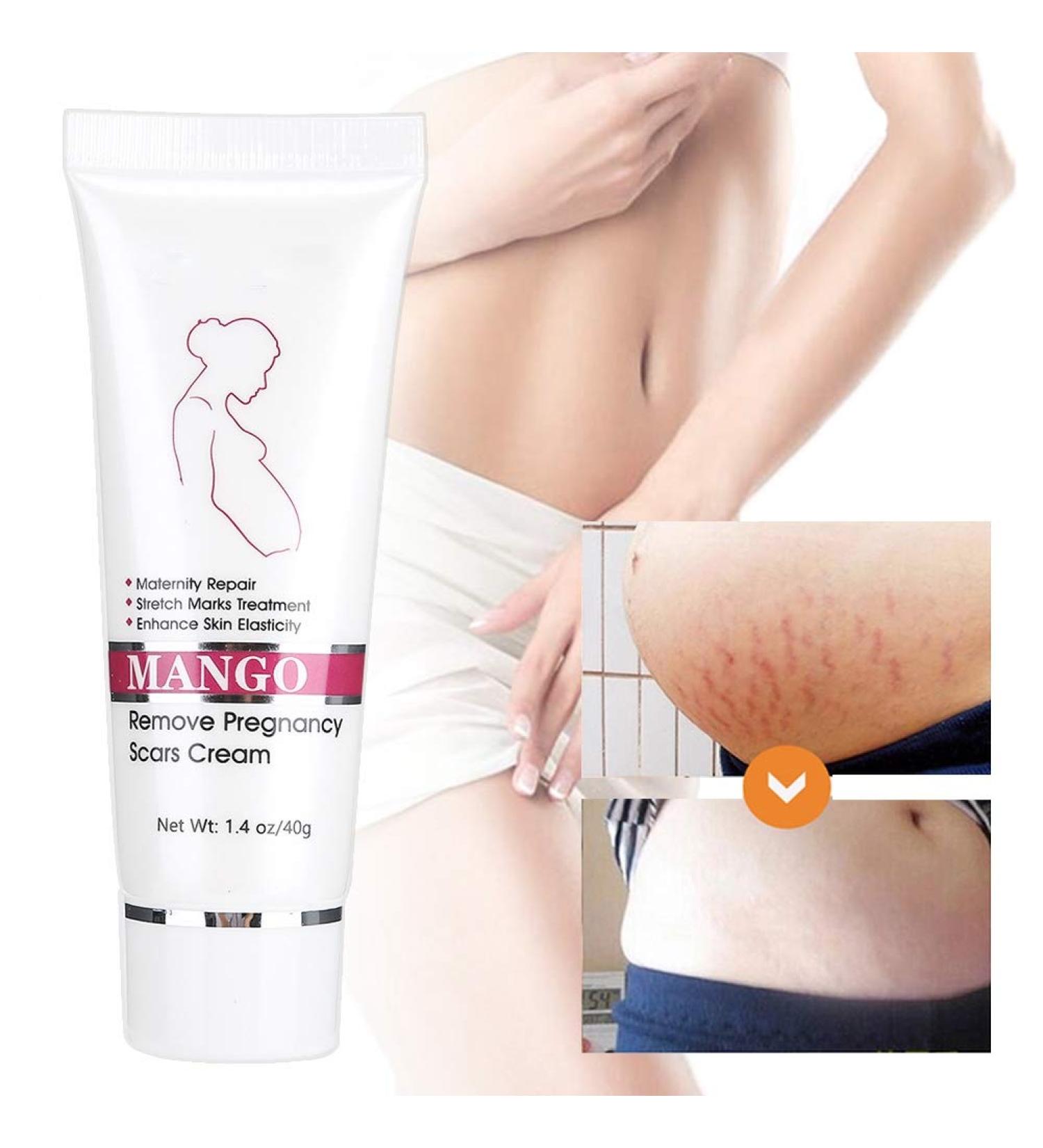 Stretch Mark Cream - Effective Pregnancy & Scar Treatment | Elimina Estr as - Buy Online on GoSupps.com