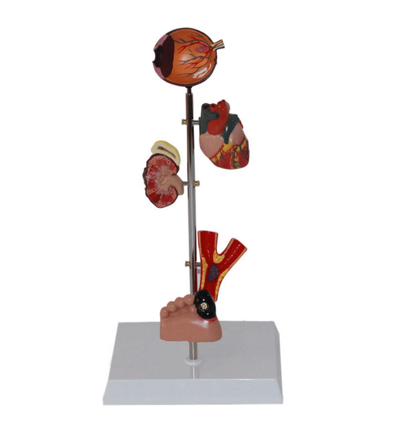 Comprehensive Human Diabetes Model: Intraocular Retinopathy Cataracts Coronary Heart Disease & More | Global Shipping Available - Buy Online on GoSupps.com